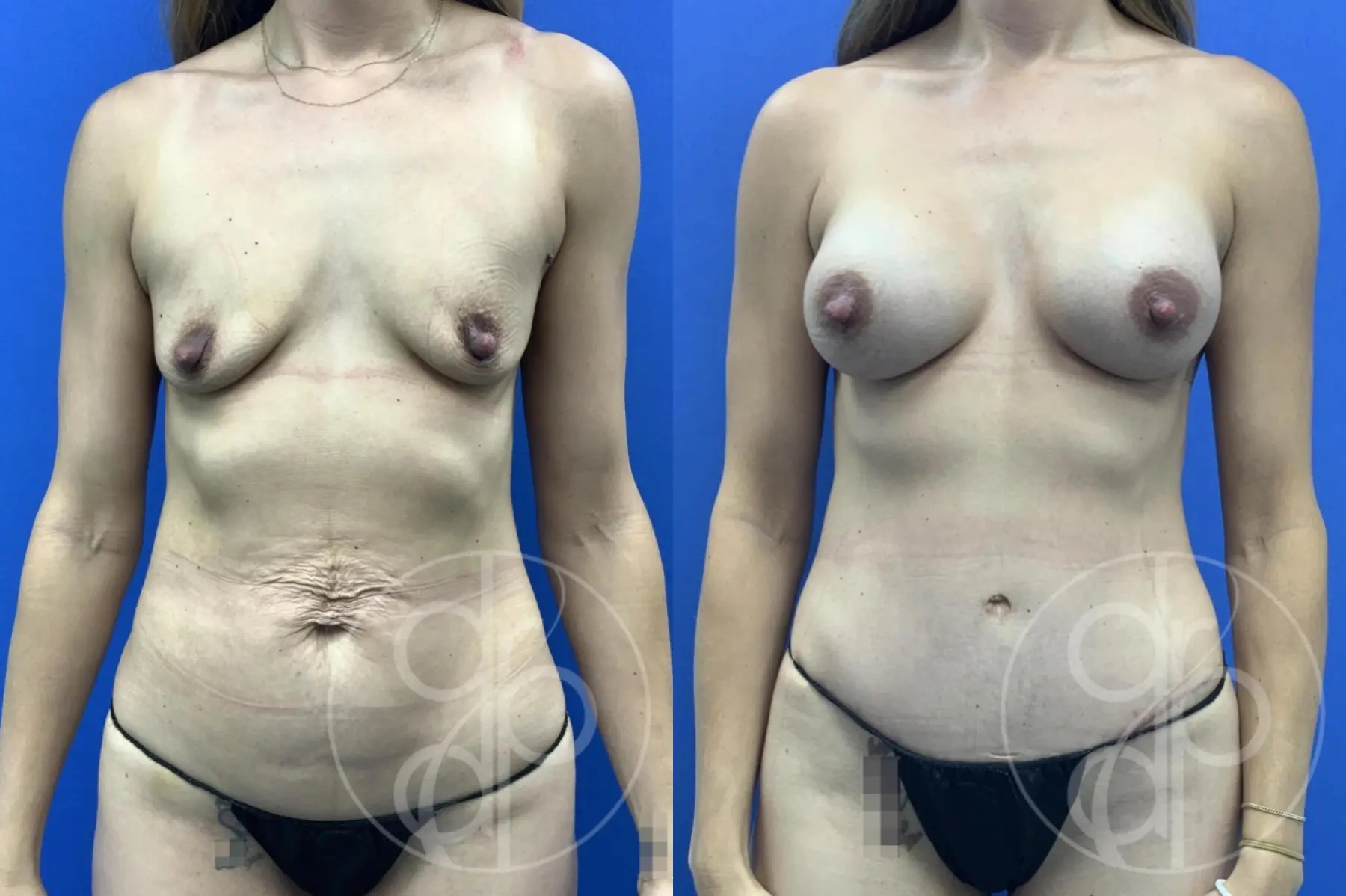 patient 14620 mommy makeover before and after result - Before and After