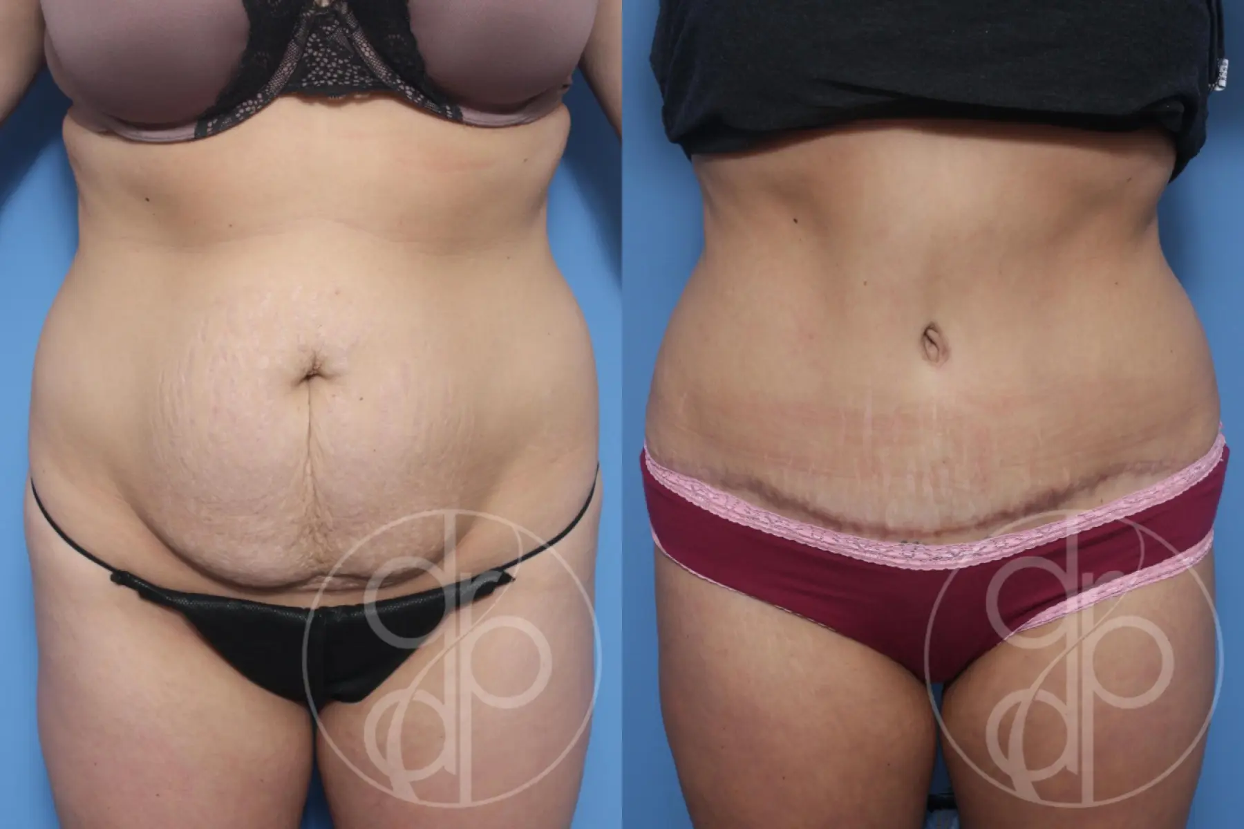 patient 11862 tummy tuck before and after result - Before and After