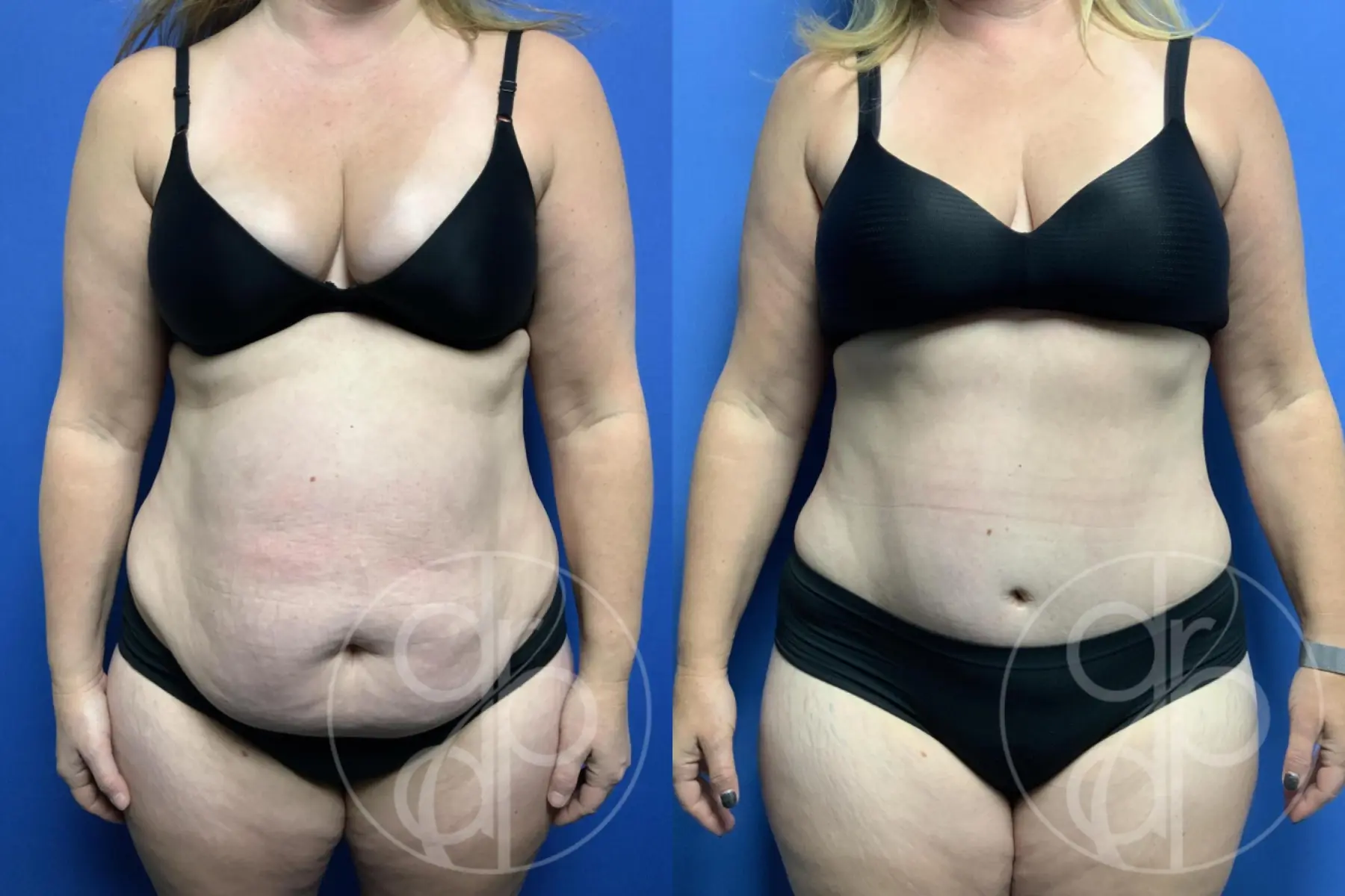 patient 10677 tummy tuck before and after result - Before and After