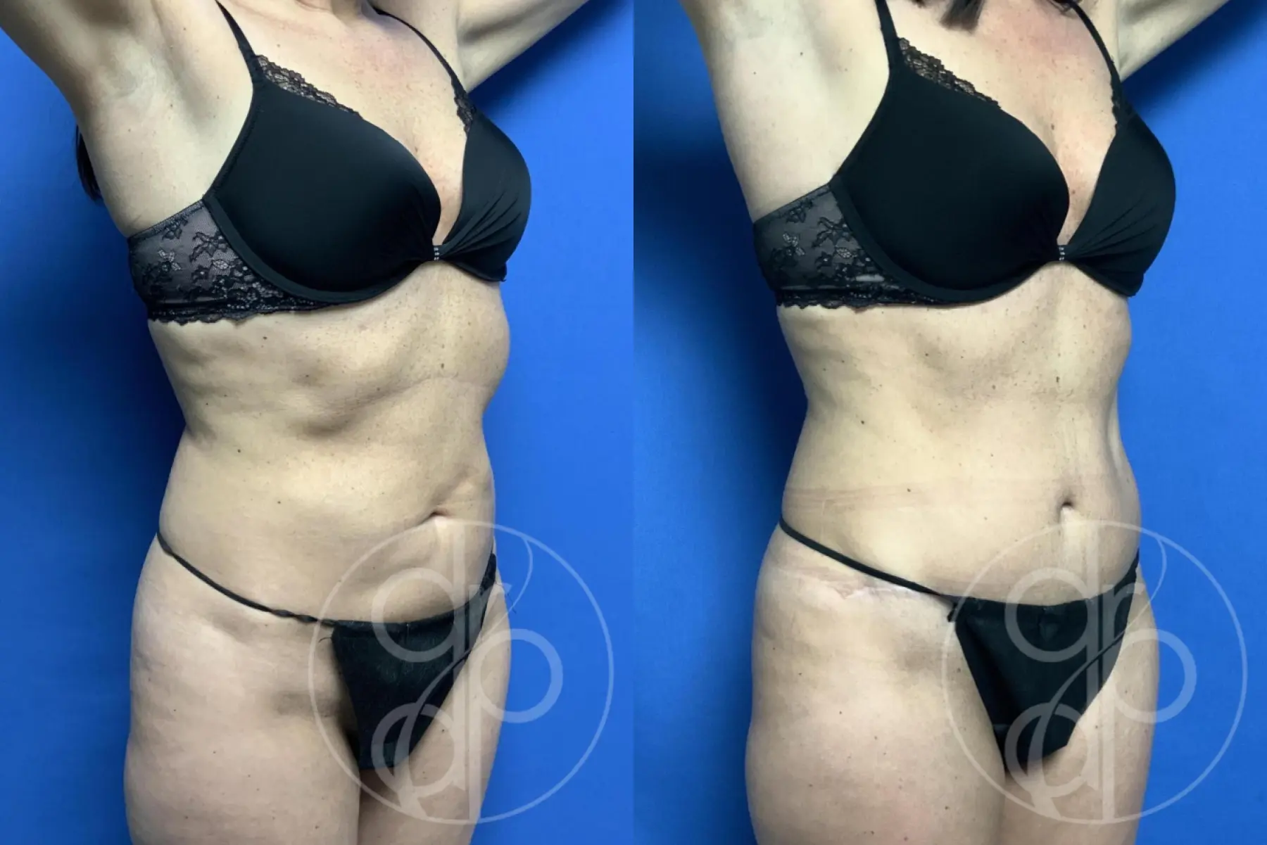 Abdominoplasty: Patient 39 - Before and After 3