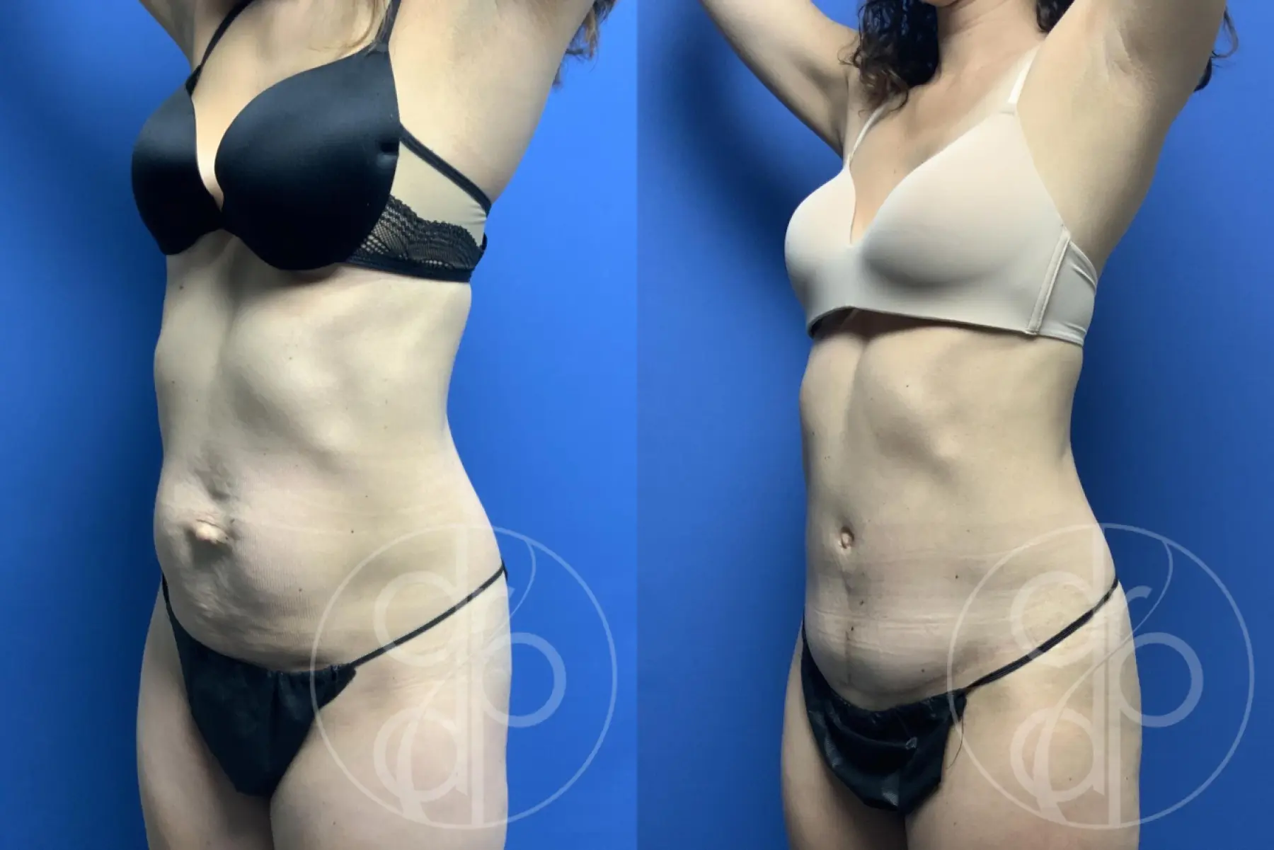 patient 12437 tummy tuck before and after result - Before and After 2