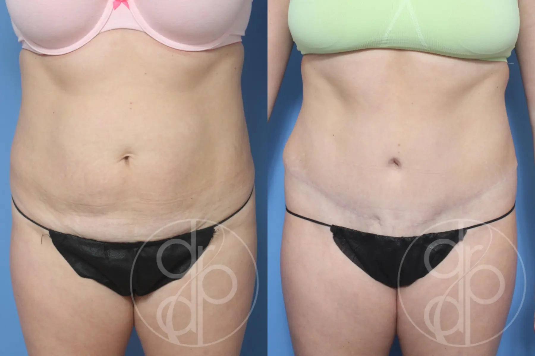 patient 13144 tummy tuck before and after result - Before and After 1