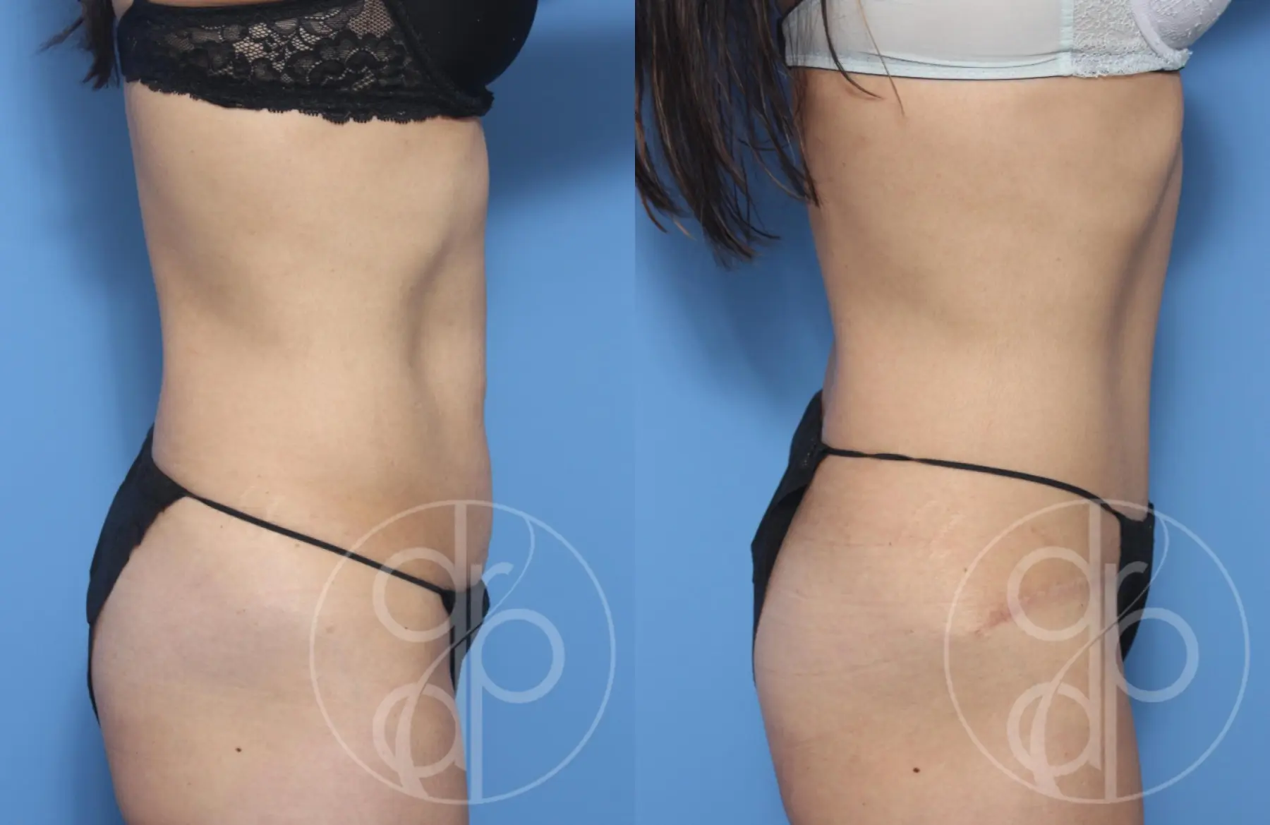 patient 13103 tummy tuck before and after result - Before and After 2