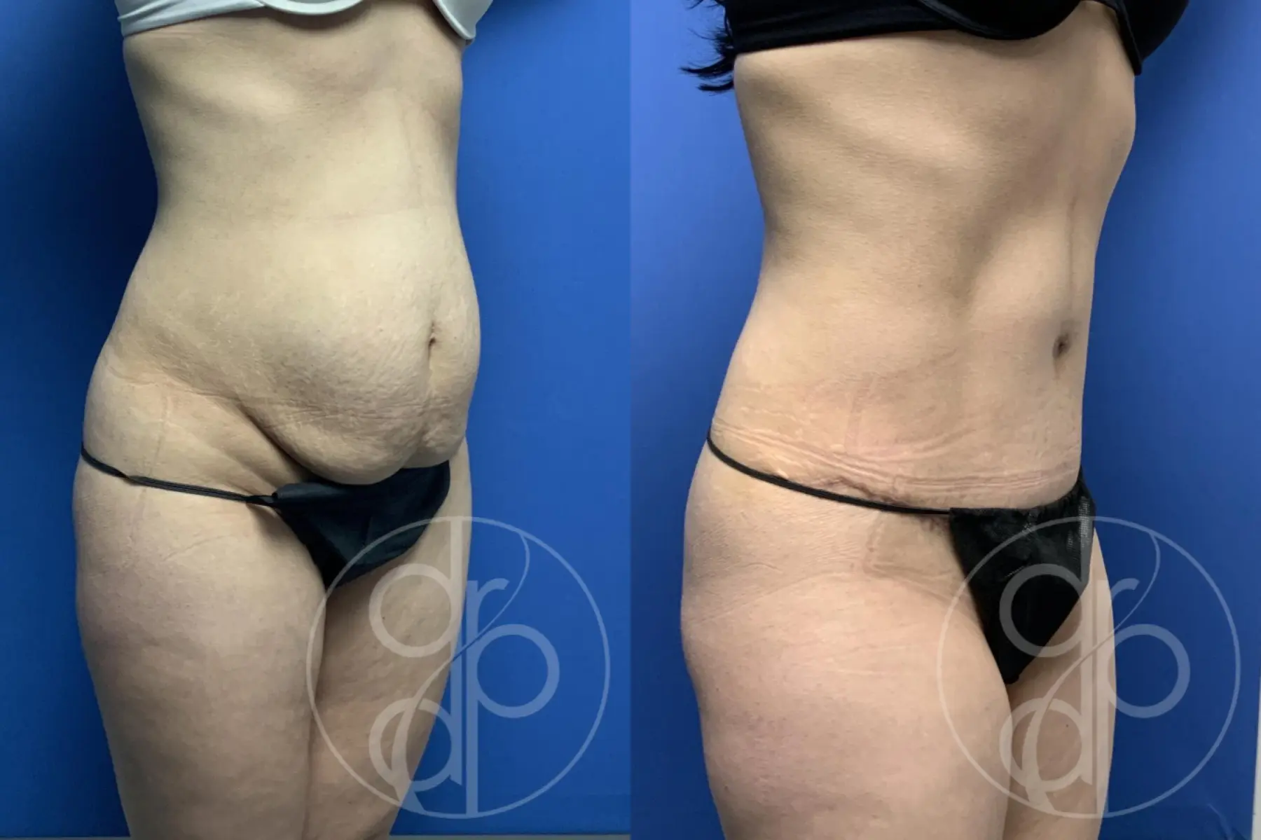 patient 13353 tummy tuck before and after result - Before and After 3