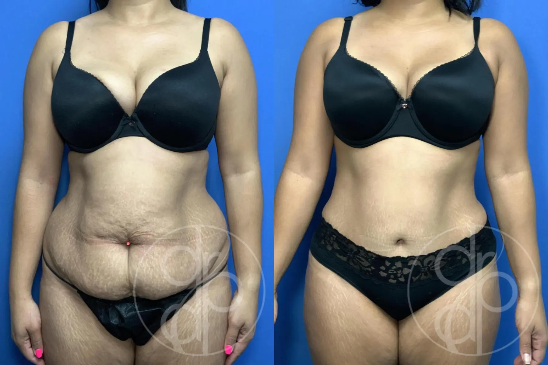 patient 13861 abdominoplasty procedure before and after result - Before and After