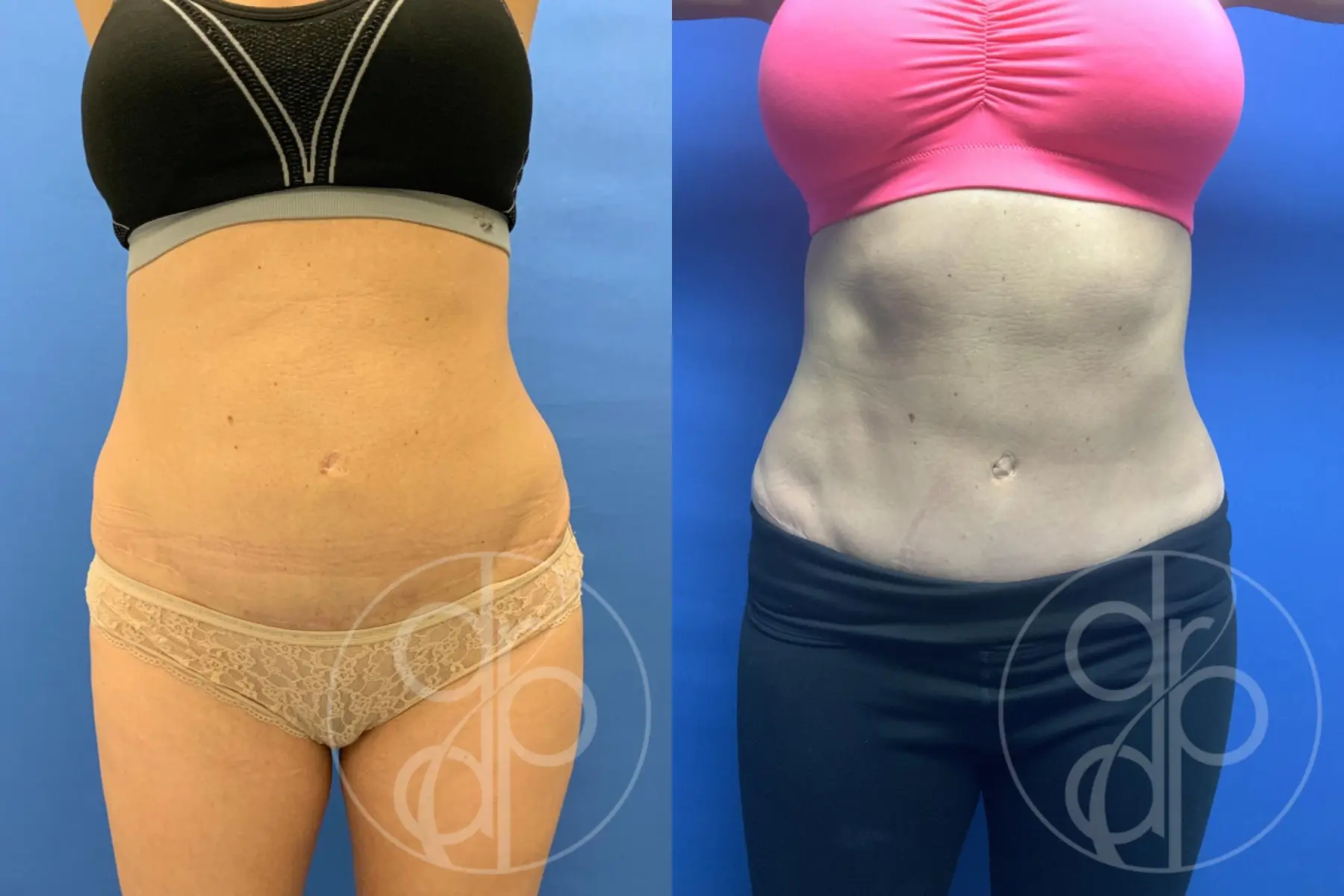 patient 10601 tummy tuck before and after result - Before and After