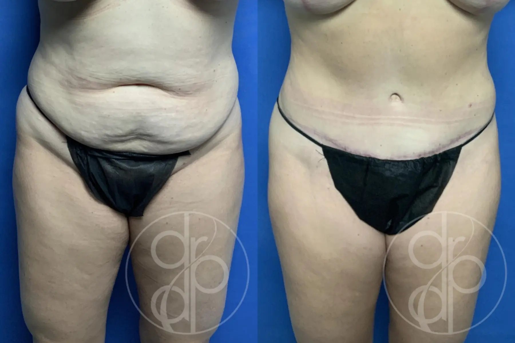 patient 12513 tummy tuck before and after result - Before and After 1