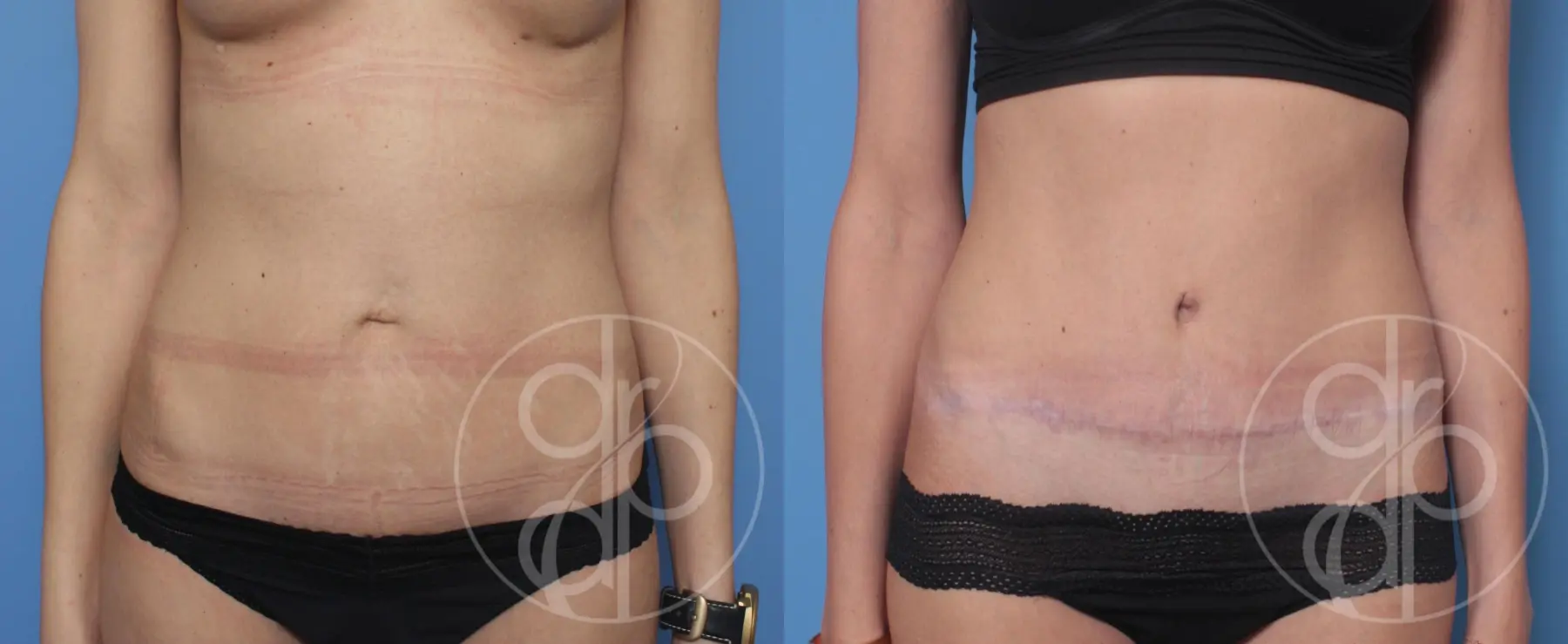 patient 10358 tummy tuck before and after result - Before and After 1