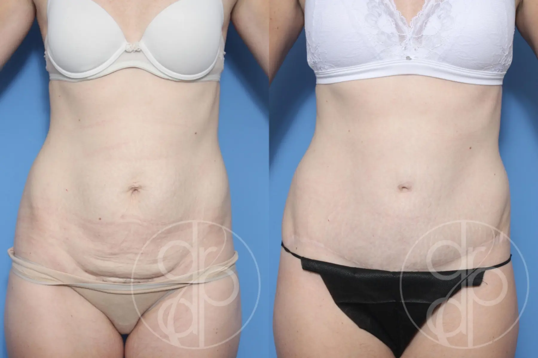patient 12804 tummy tuck before and after result - Before and After 2