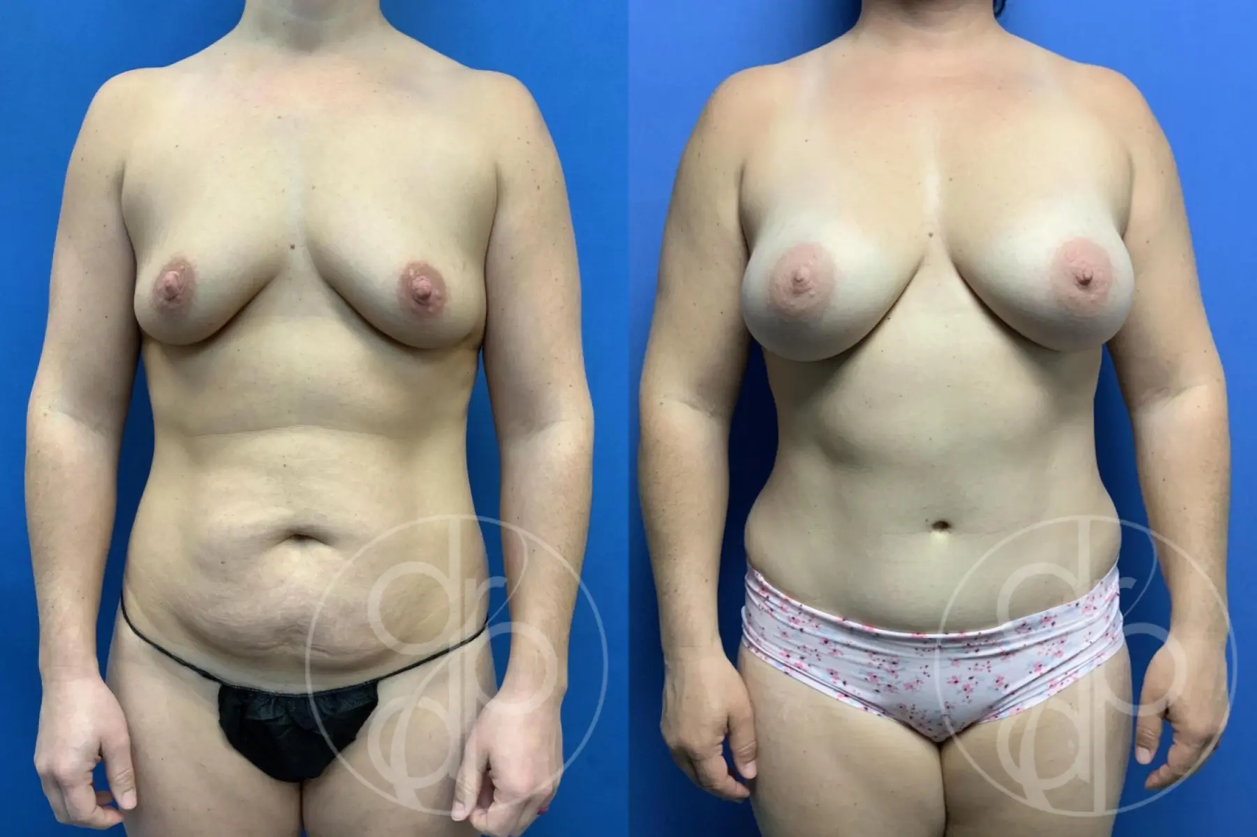 patient 10634 mommy makeover before and after result - Before and After