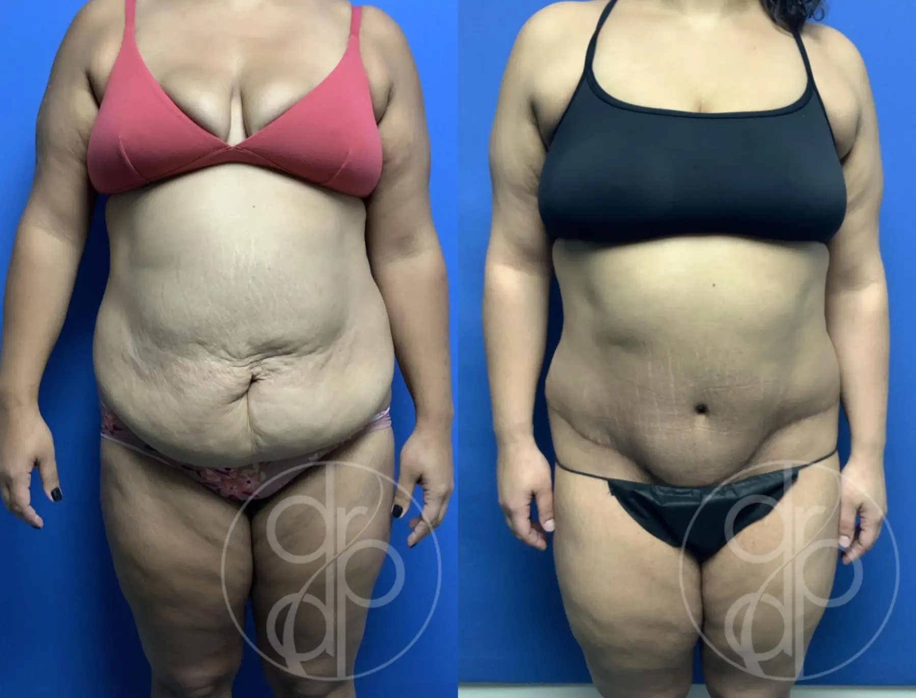 patient 13562 tummy tuck before and after result - Before and After 1