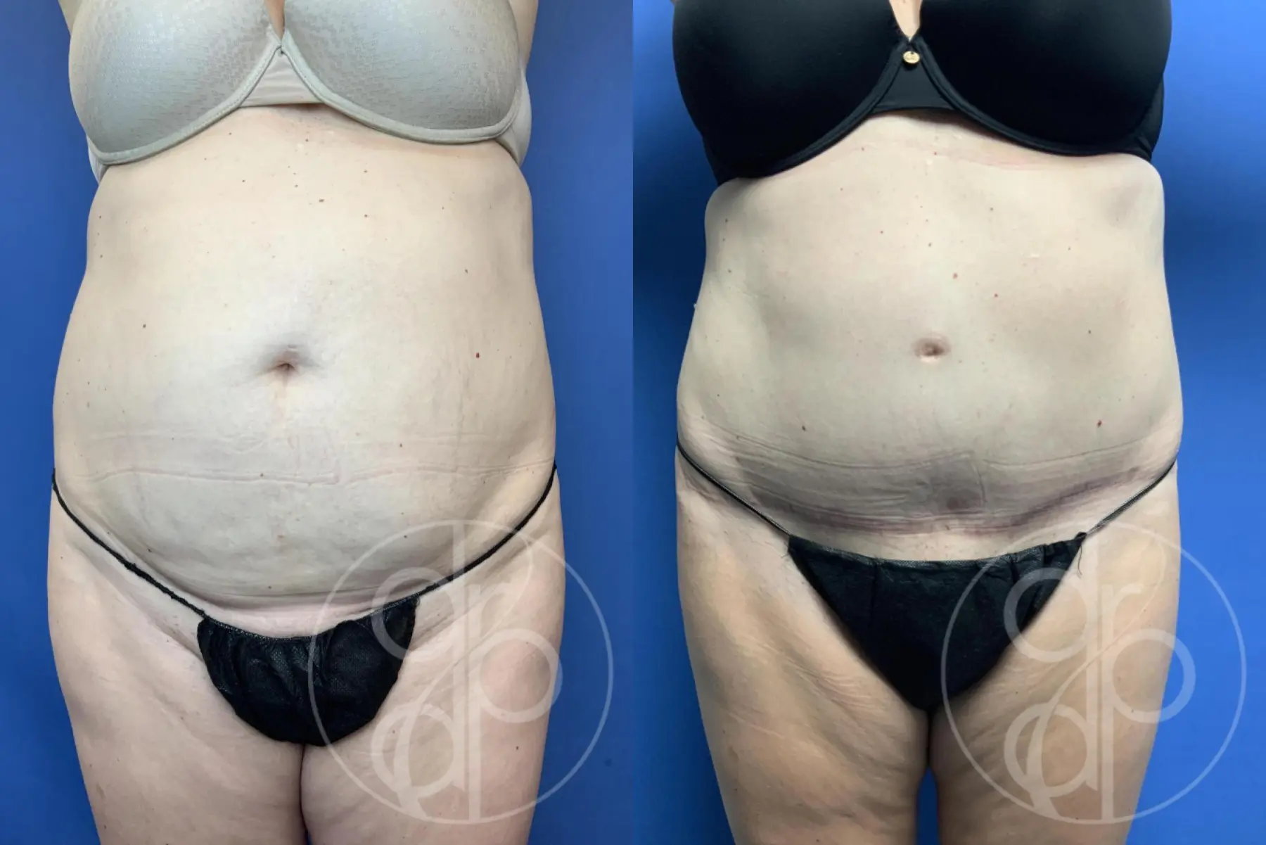 patient 10705 abdominoplasty procedure before and after result - Before and After