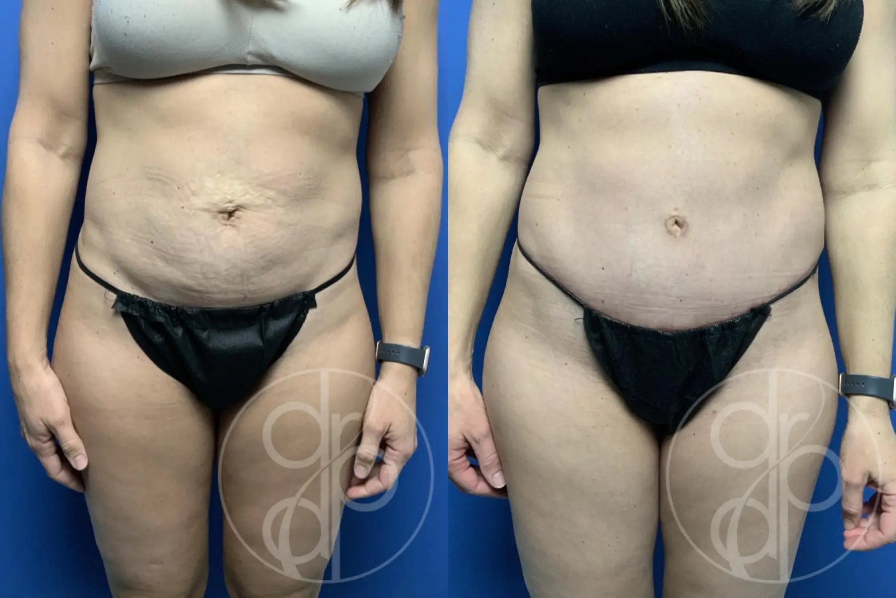 patient 12369 tummy tuck before and after result - Before and After 1