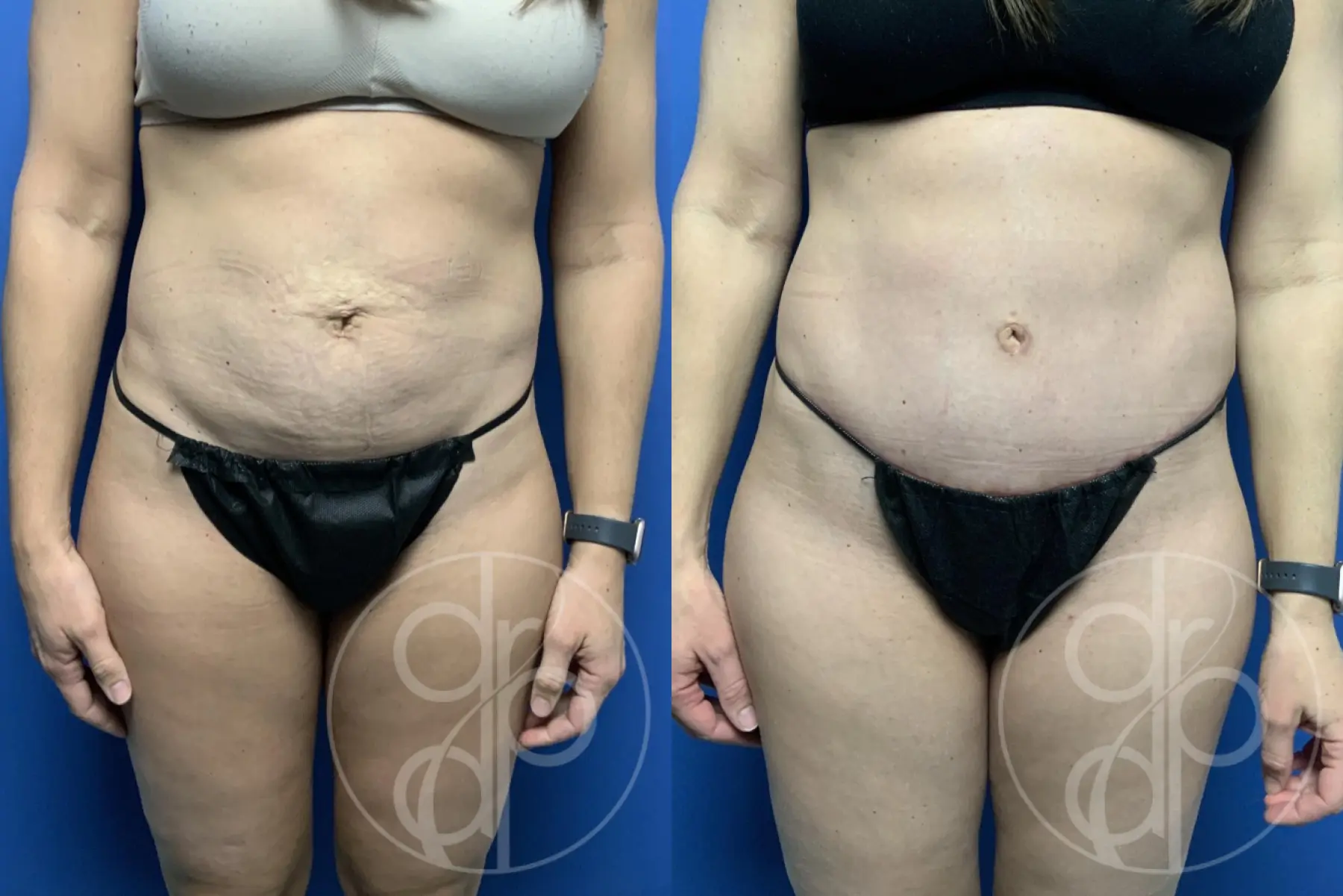 patient 12369 tummy tuck before and after result - Before and After