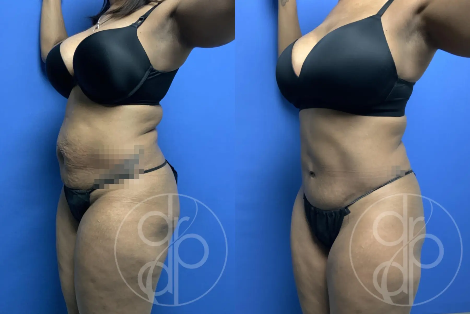 patient 13351 tummy tuck before and after result - Before and After 3