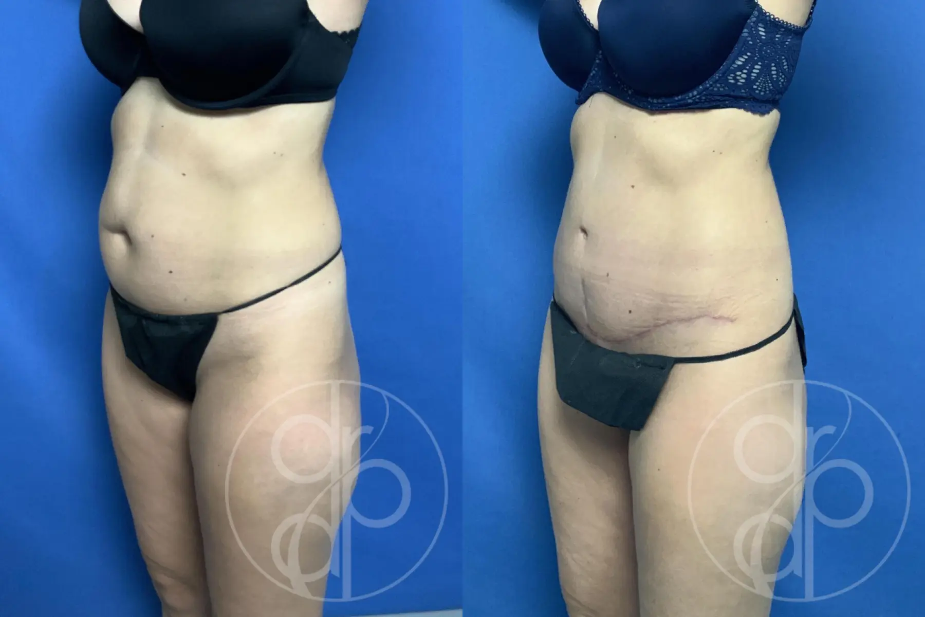 patient 12620 tummy tuck before and after result - Before and After 2