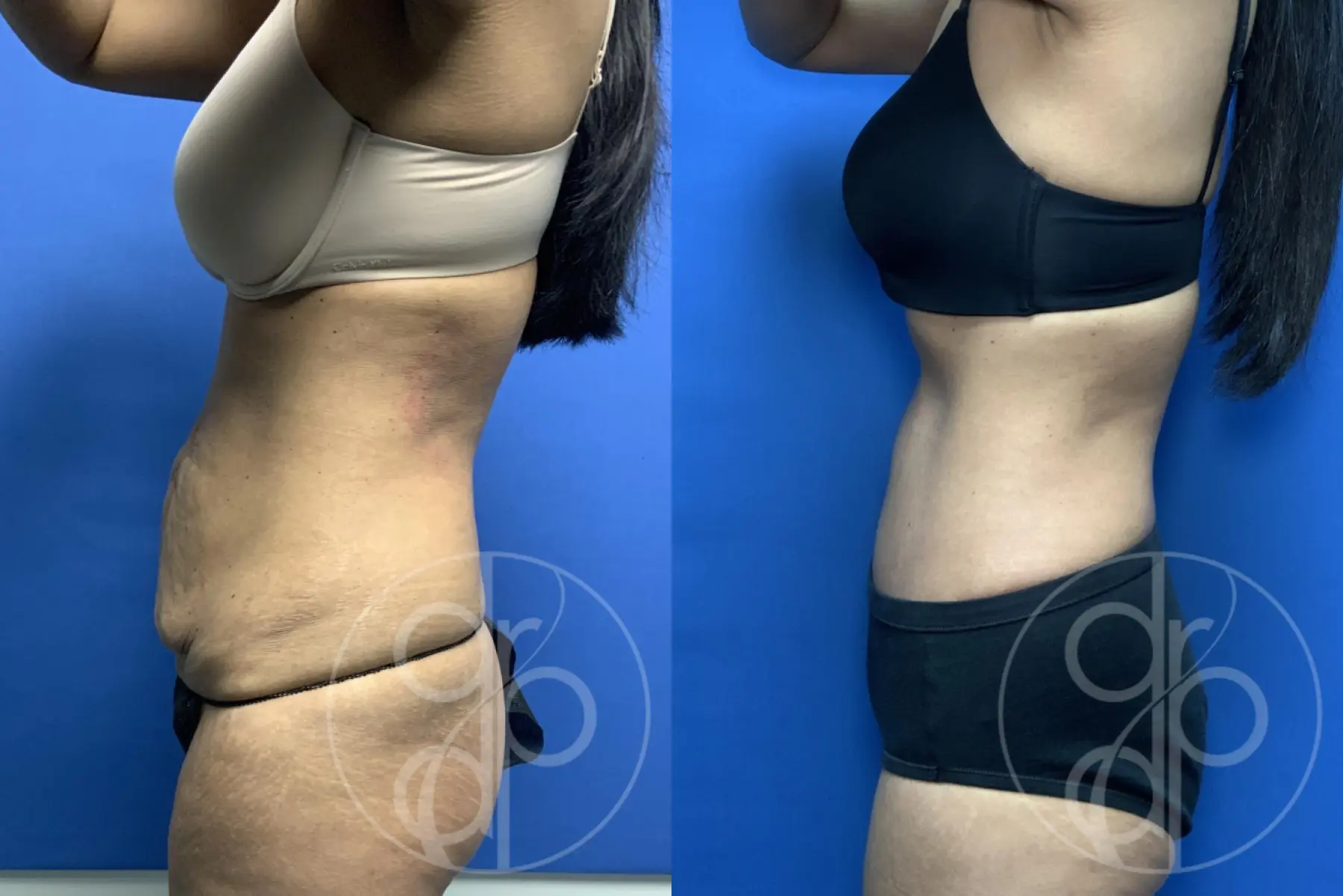 patient 13839 tummy tuck before and after result - Before and After 3