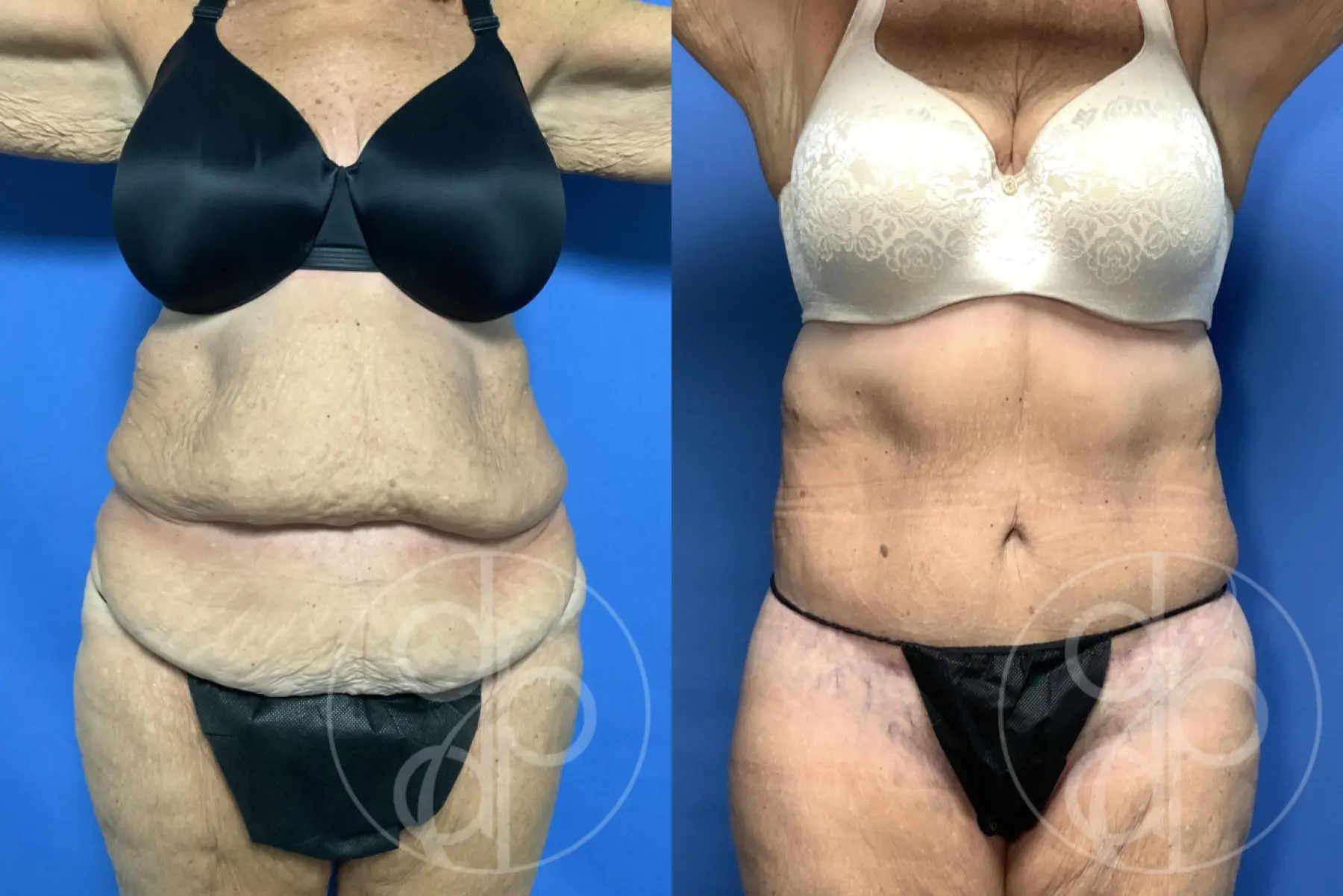 Abdominoplasty: Patient 36 - Before and After 2