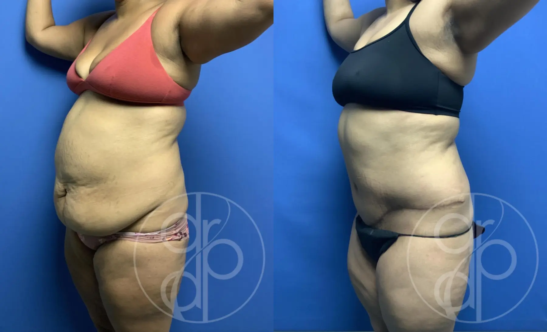 patient 13562 tummy tuck before and after result - Before and After 3