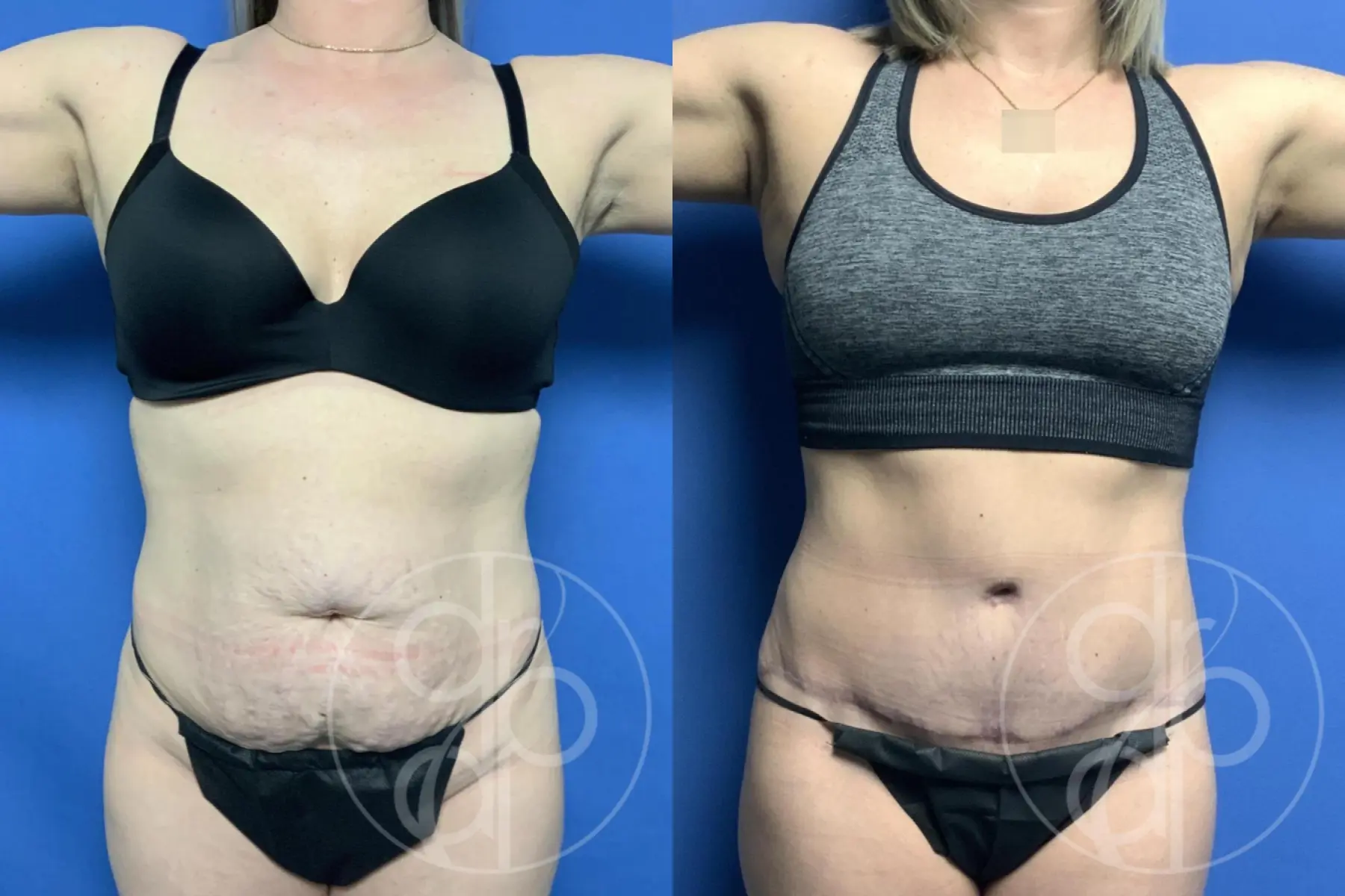 patient 12443 abdominoplasty procedure before and after result - Before and After