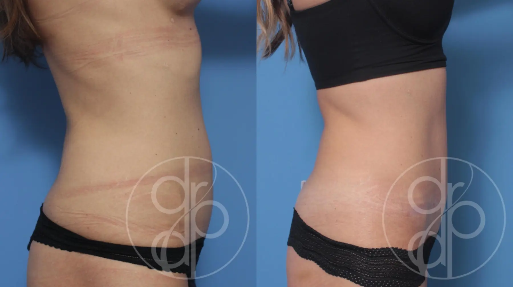 patient 10358 tummy tuck before and after result - Before and After 2