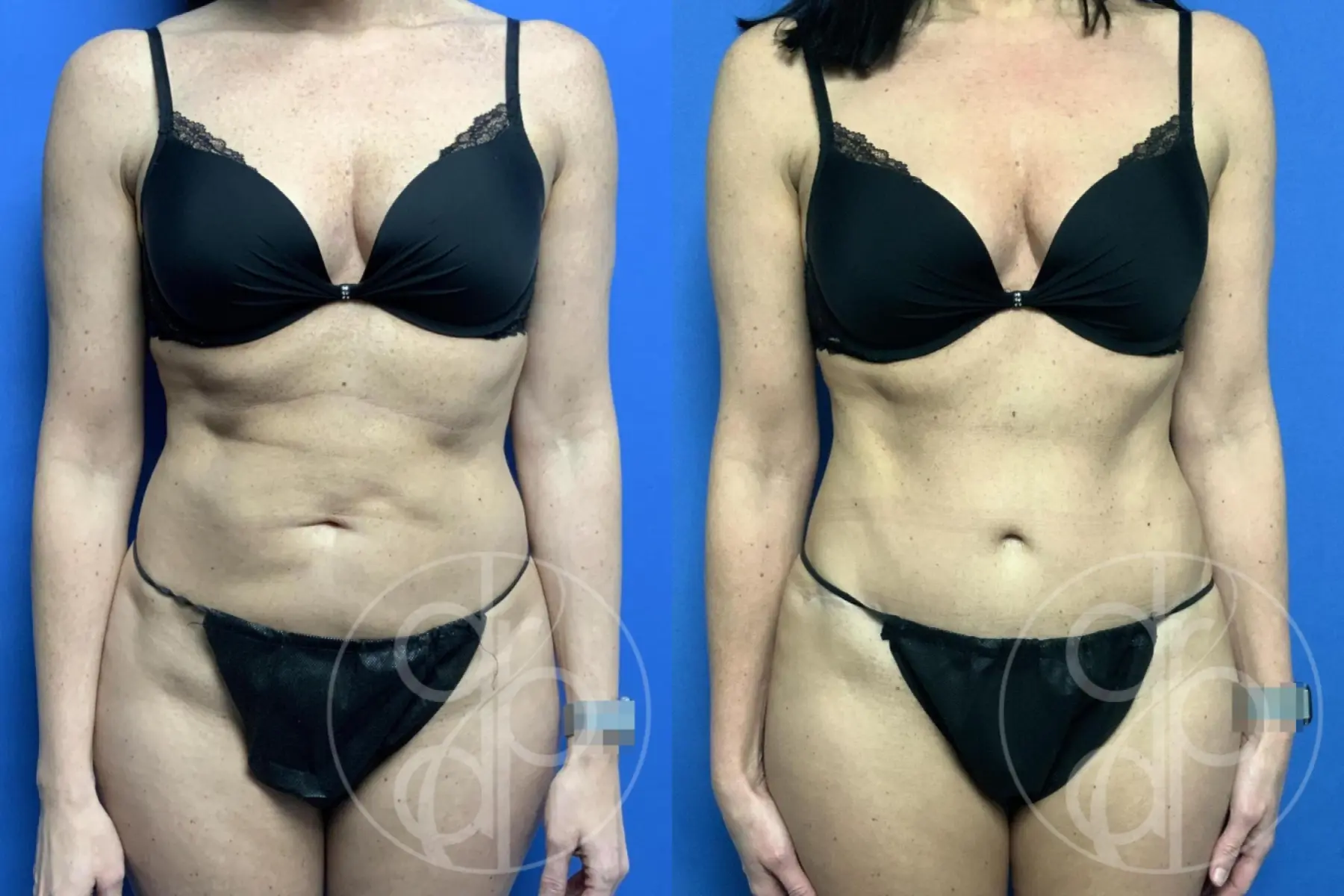 patient 12682 abdominoplasty procedure before and after result - Before and After