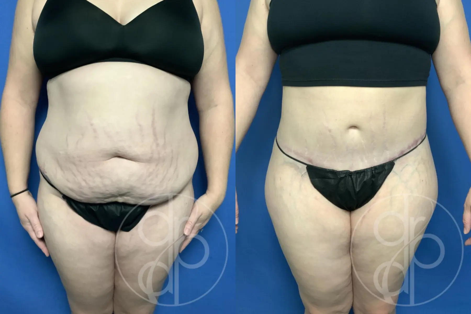 patient 13377 tummy tuck before and after result - Before and After 1