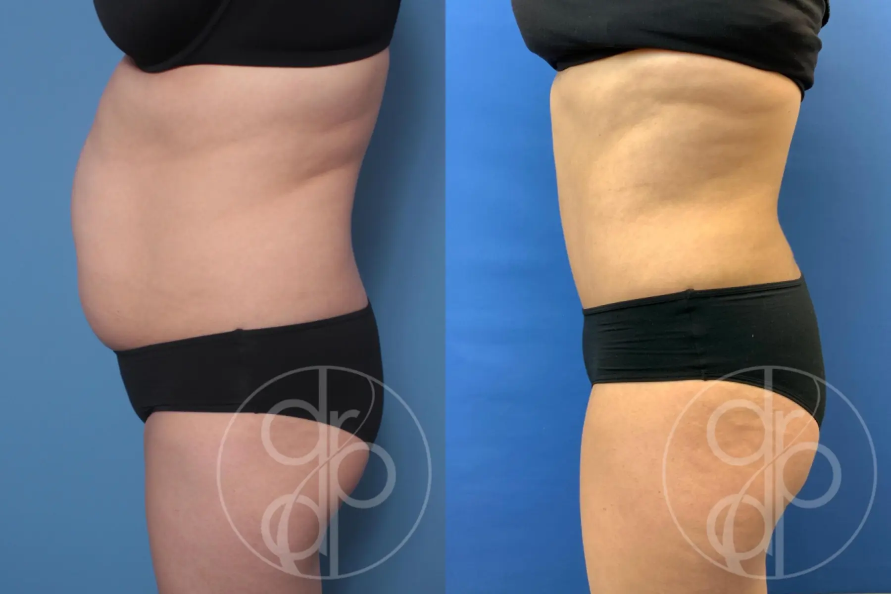 patient 10163 tummy tuck before and after result - Before and After 2
