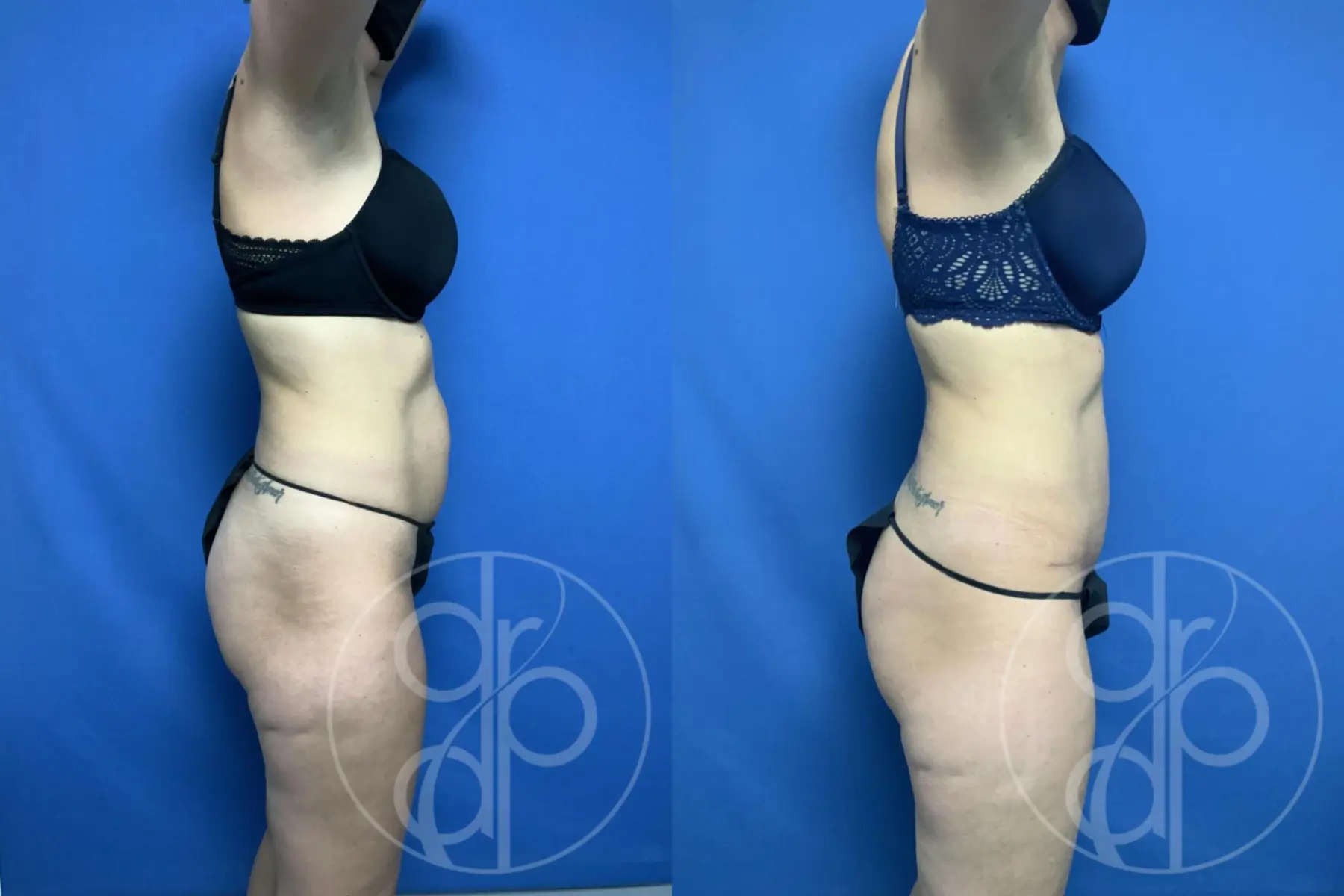 patient 12620 tummy tuck before and after result - Before and After 1