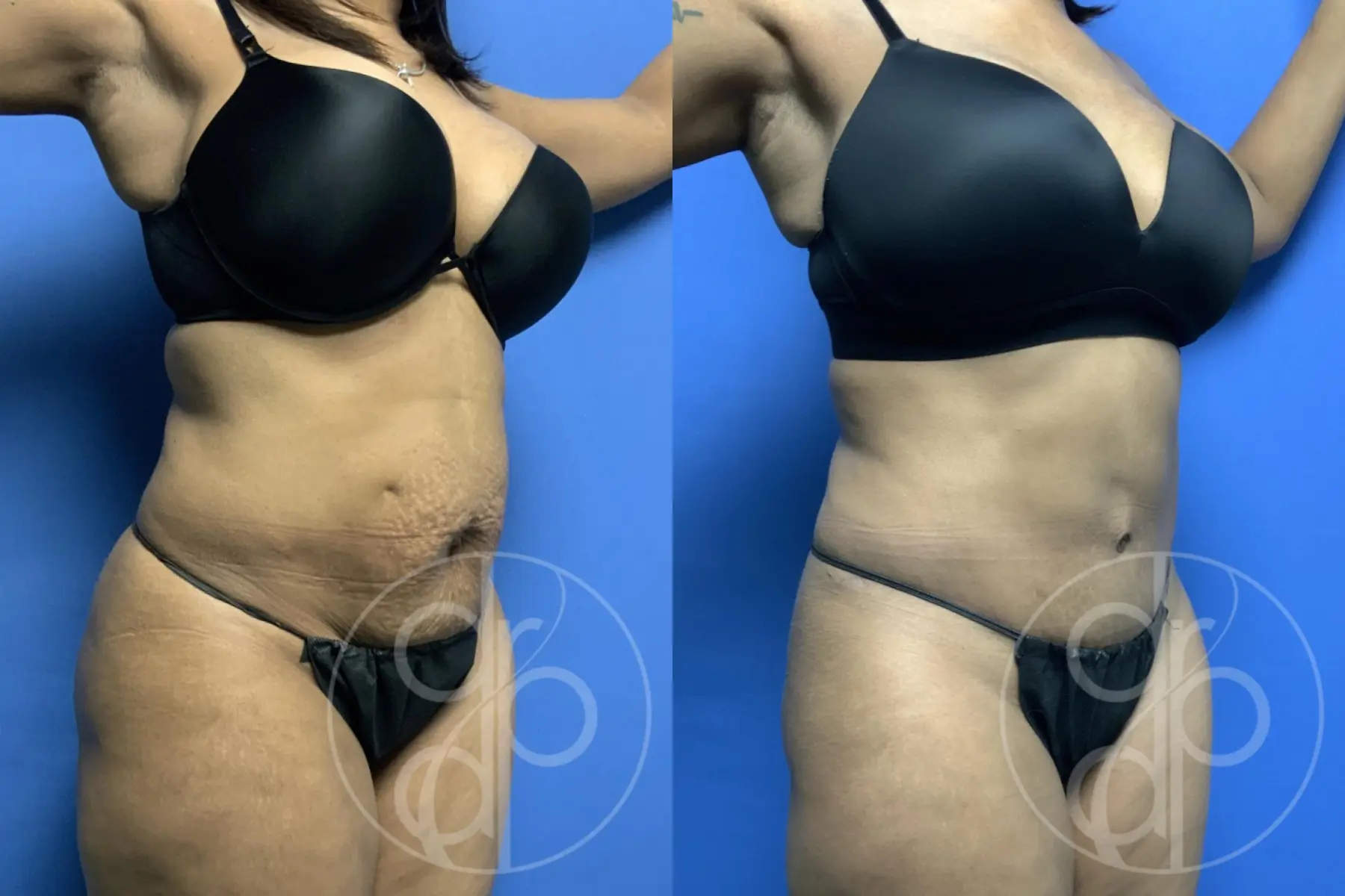 patient 13351 tummy tuck before and after result - Before and After 2