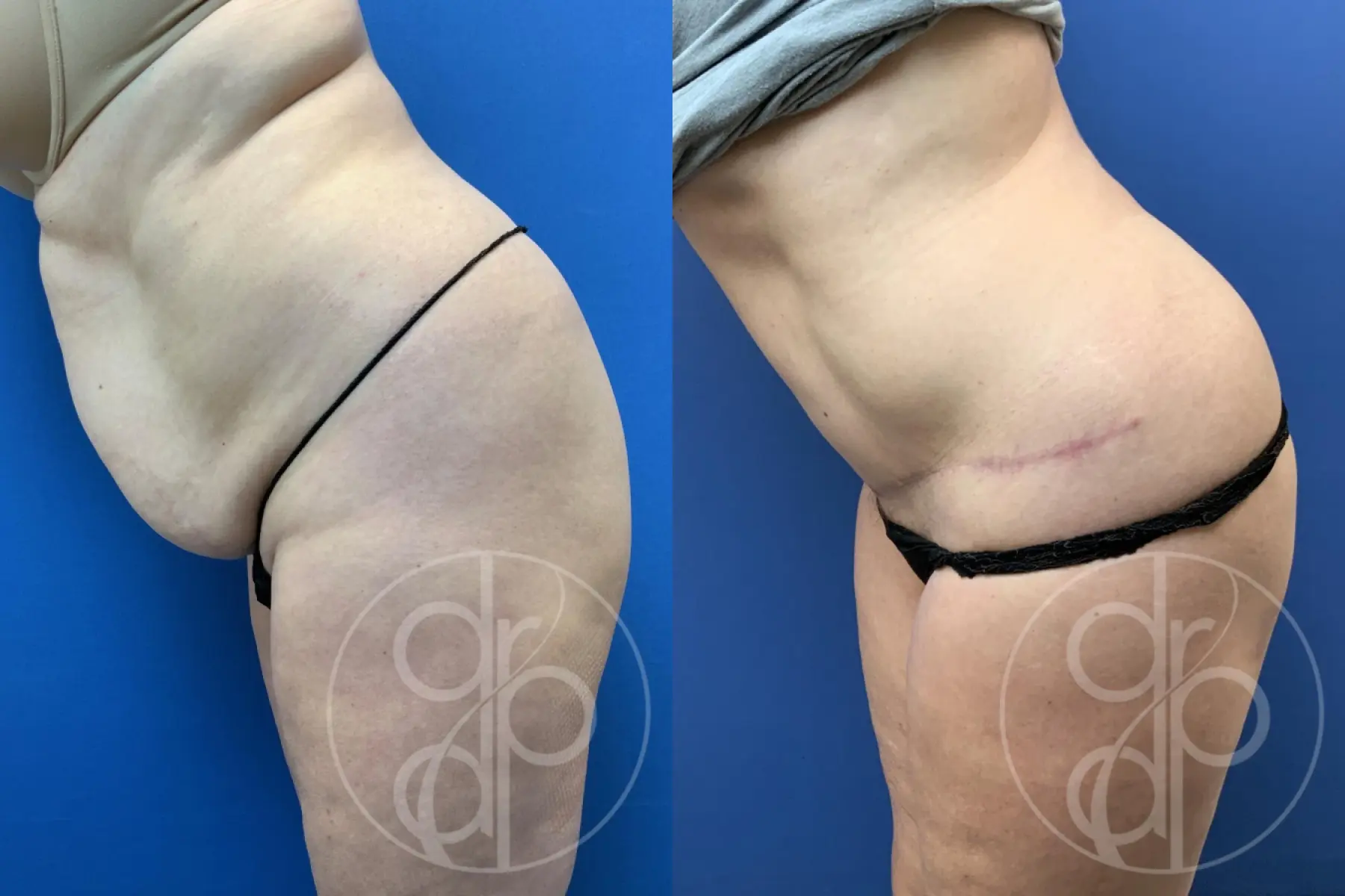 patient 10745 tummy tuck before and after result - Before and After 2
