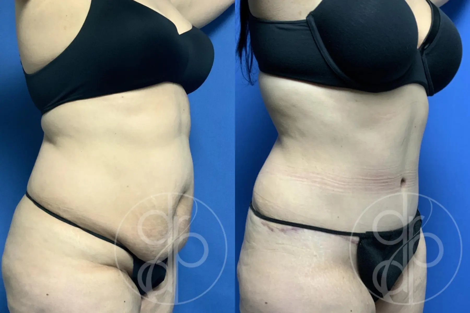 patient 13394 tummy tuck before and after result - Before and After 2