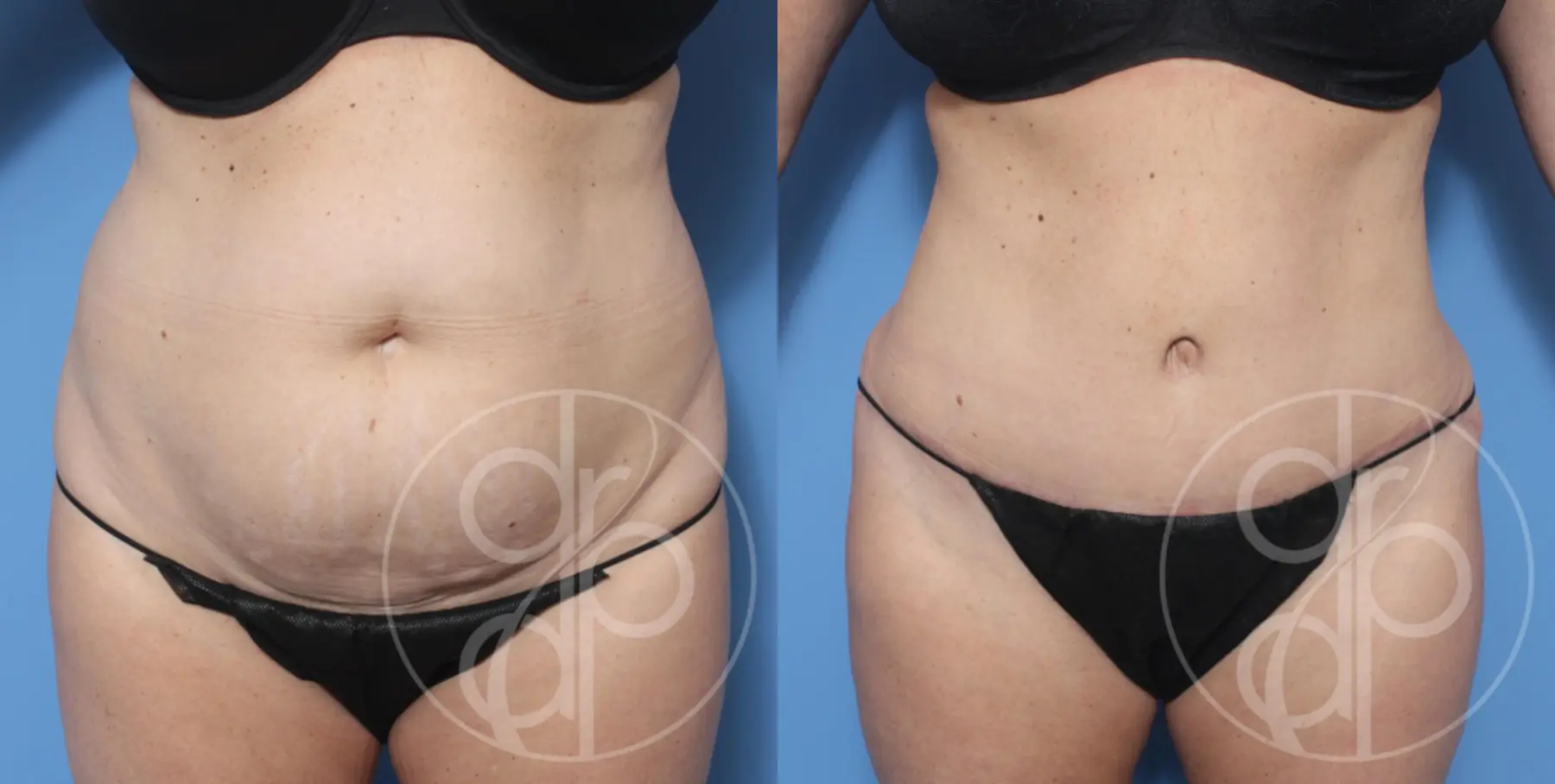 patient 12974 tummy tuck before and after result - Before and After 1