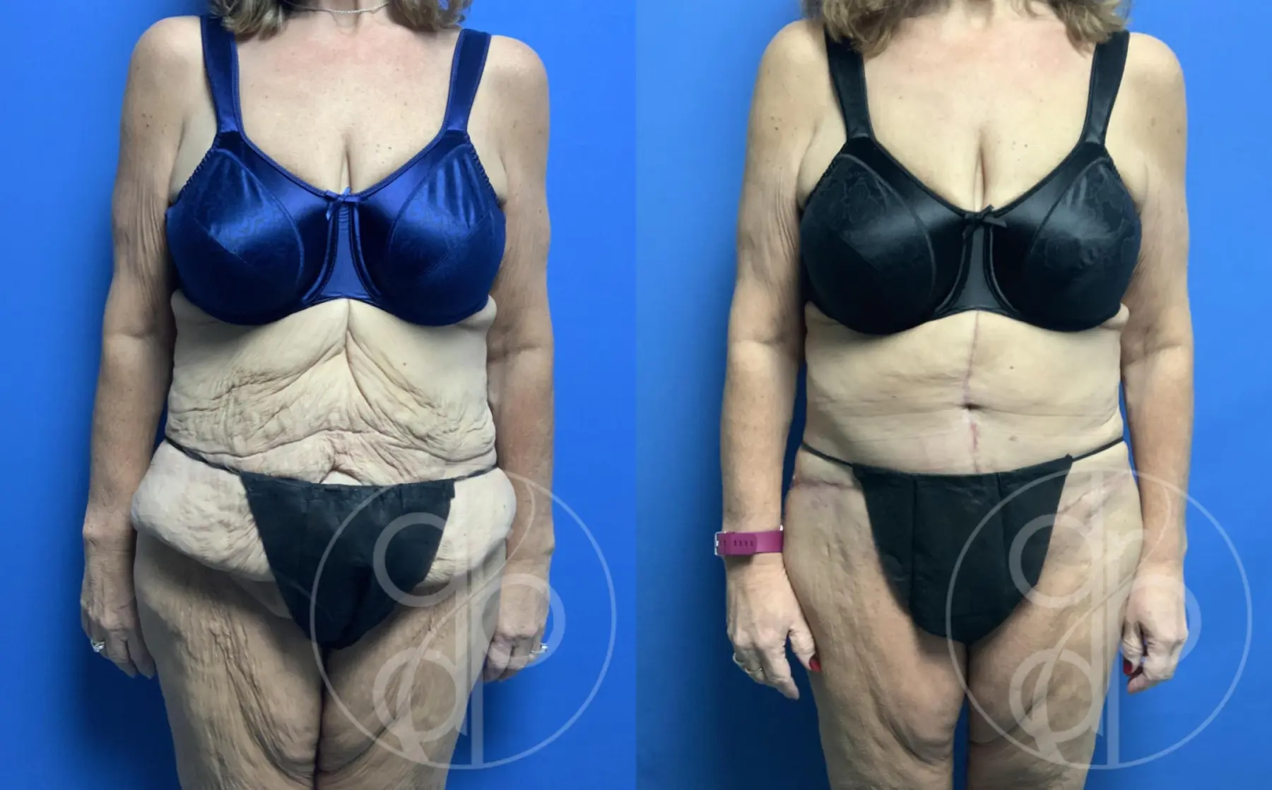 patient 12155 tummy tuck before and after result - Before and After 1