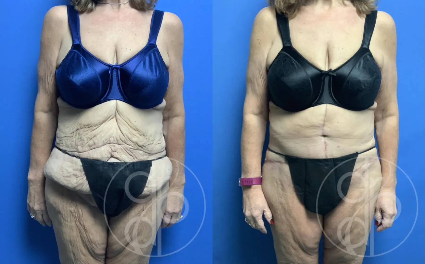 patient 12155 tummy tuck before and after result - Before and After