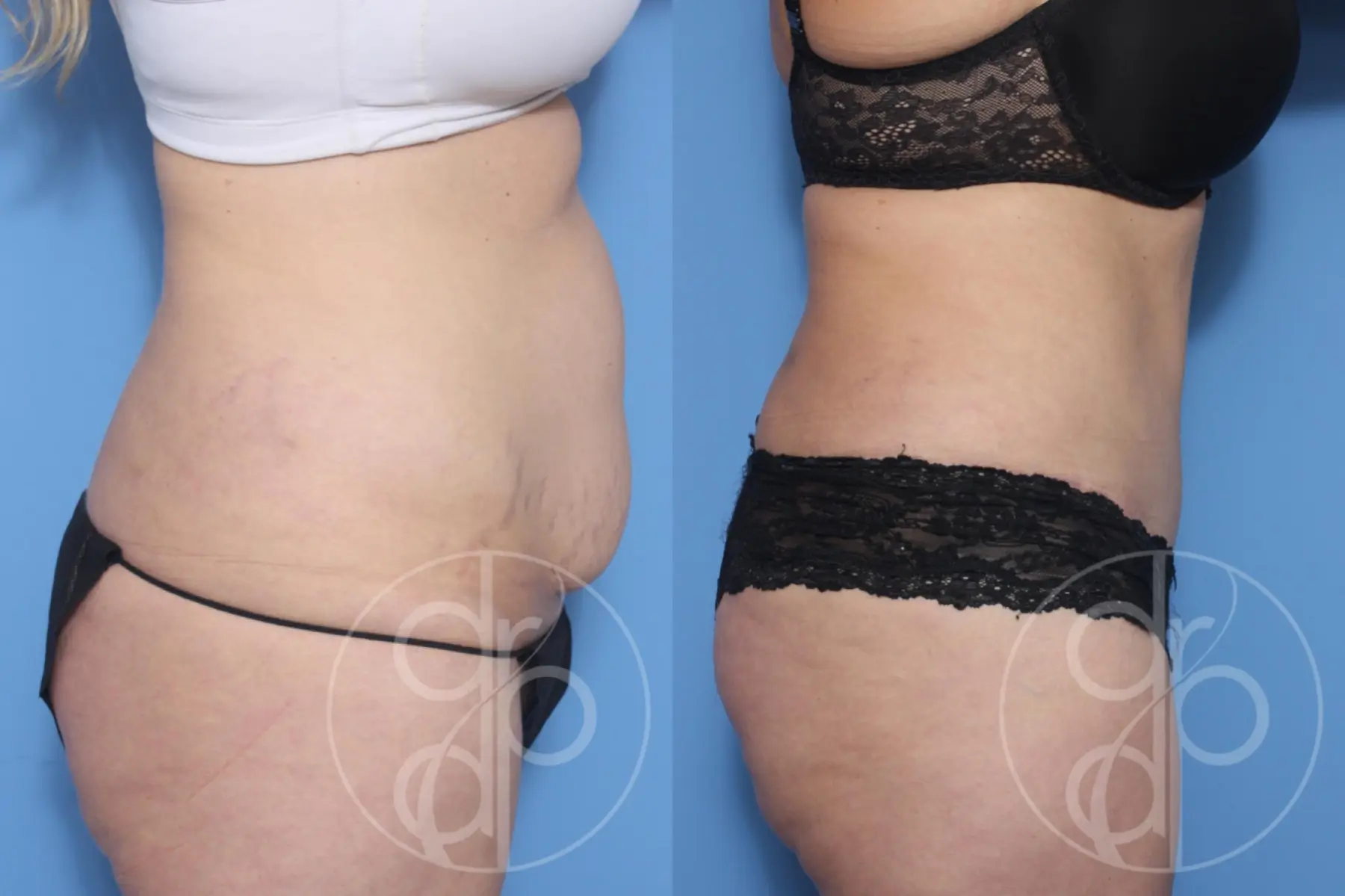 patient 12941 tummy tuck before and after result - Before and After 2