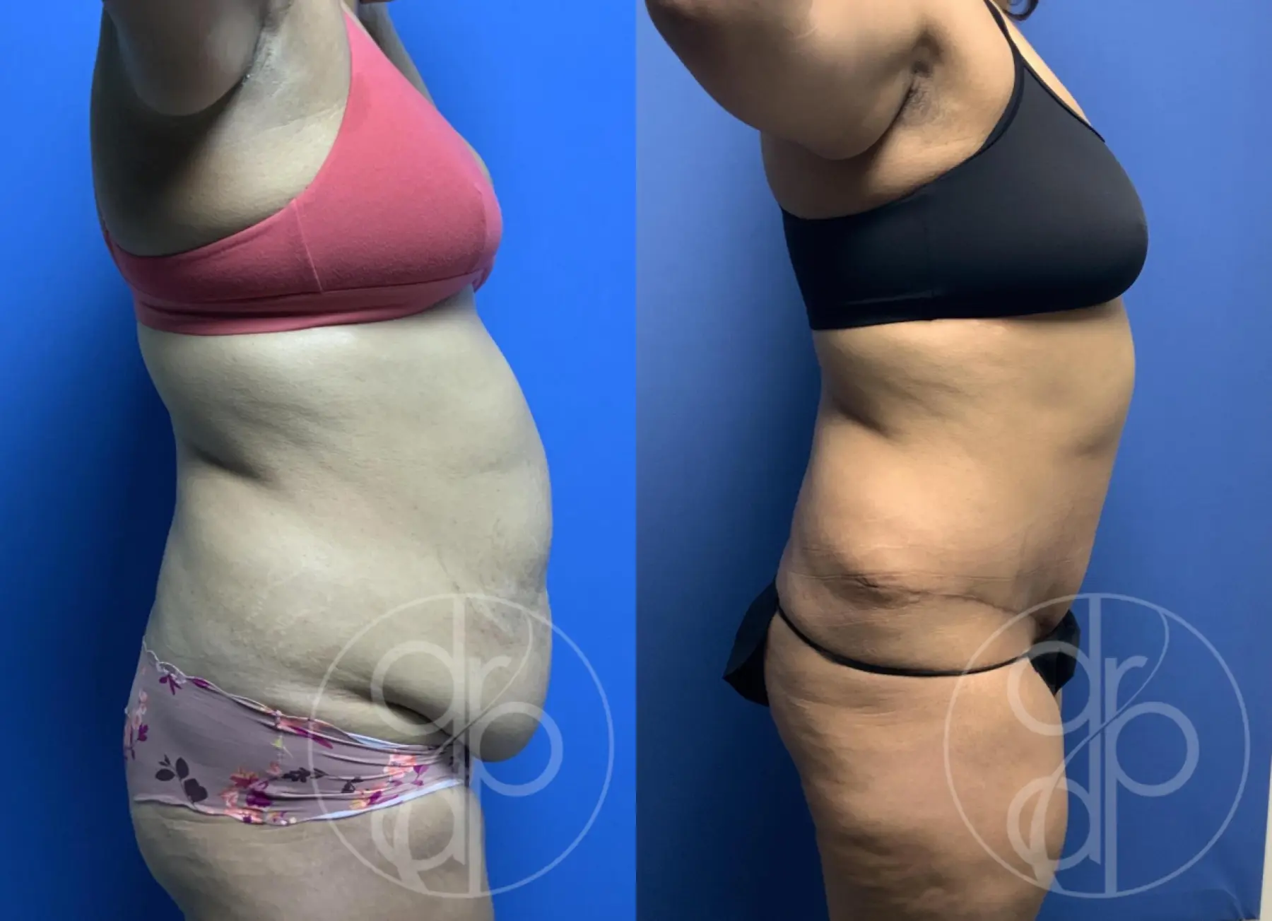 patient 13562 tummy tuck before and after result - Before and After 2