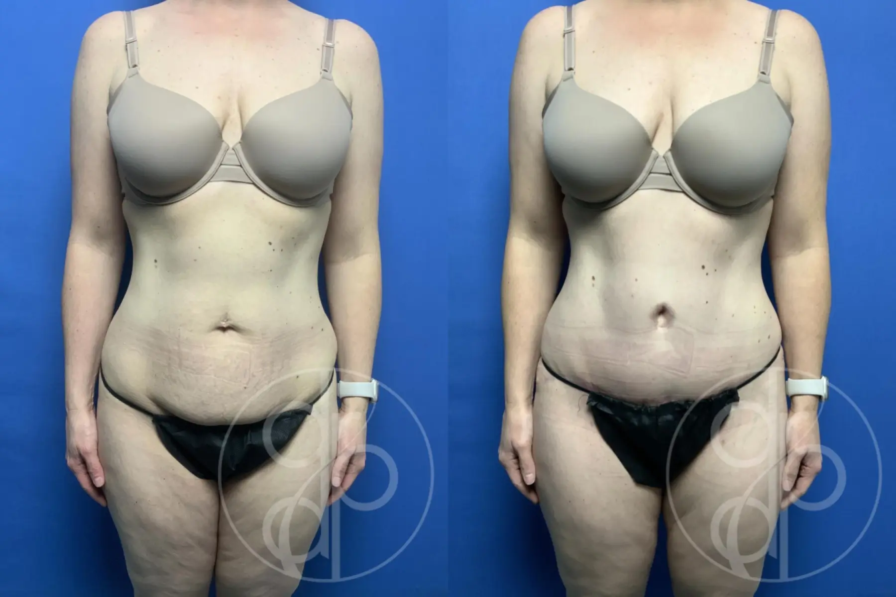 patient 12636 tummy tuck before and after result - Before and After