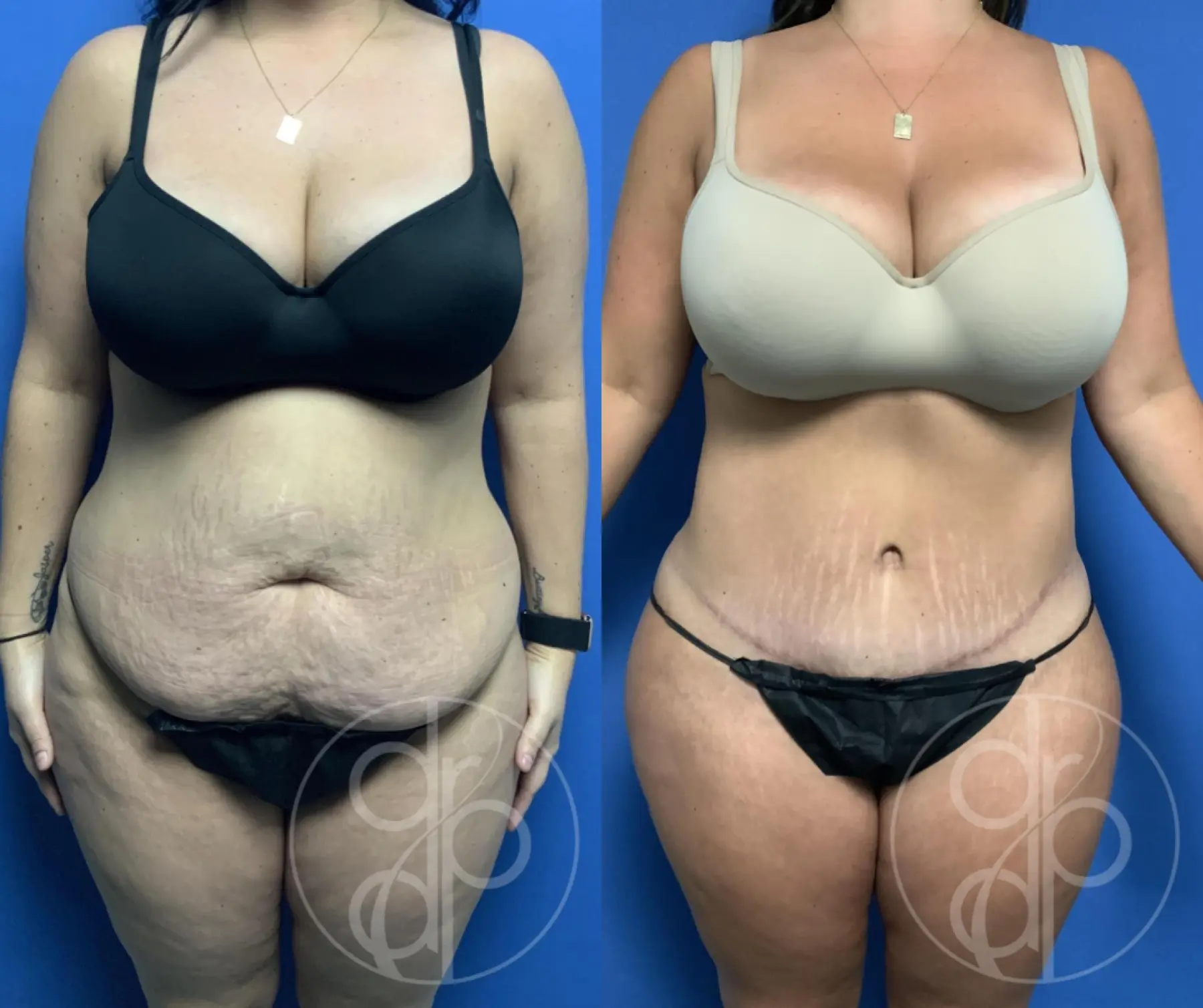 patient 12668 tummy tuck before and after result - Before and After 1