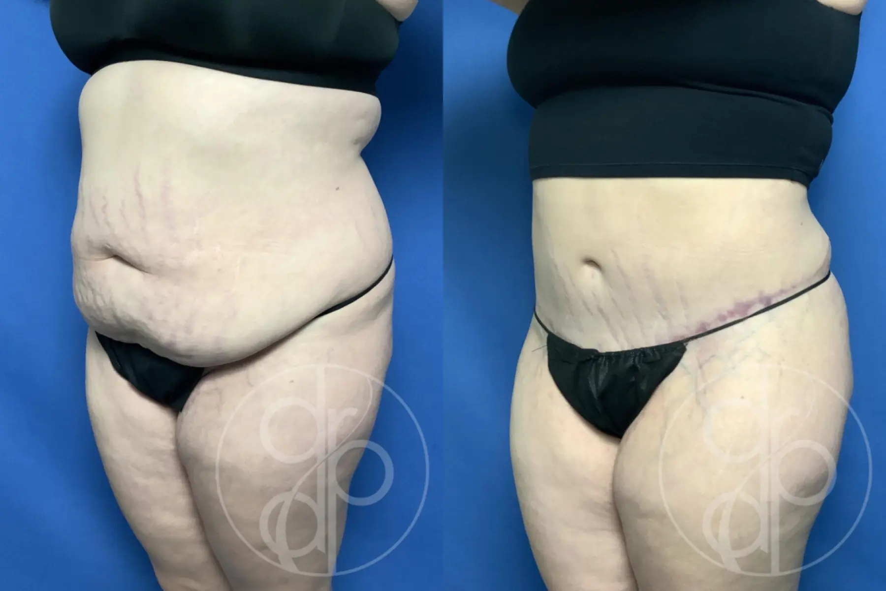 patient 13377 tummy tuck before and after result - Before and After 3