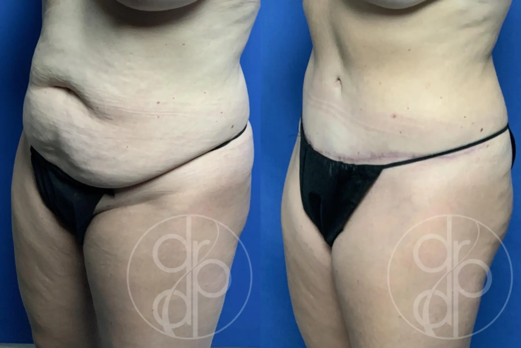 patient 12513 tummy tuck before and after result - Before and After 3