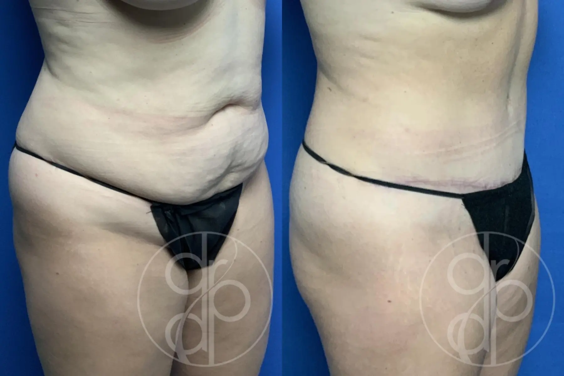 patient 12513 tummy tuck before and after result - Before and After 2
