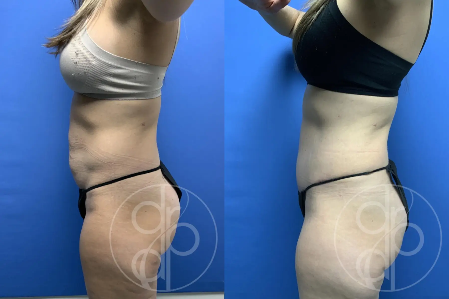 patient 12369 tummy tuck before and after result - Before and After 5