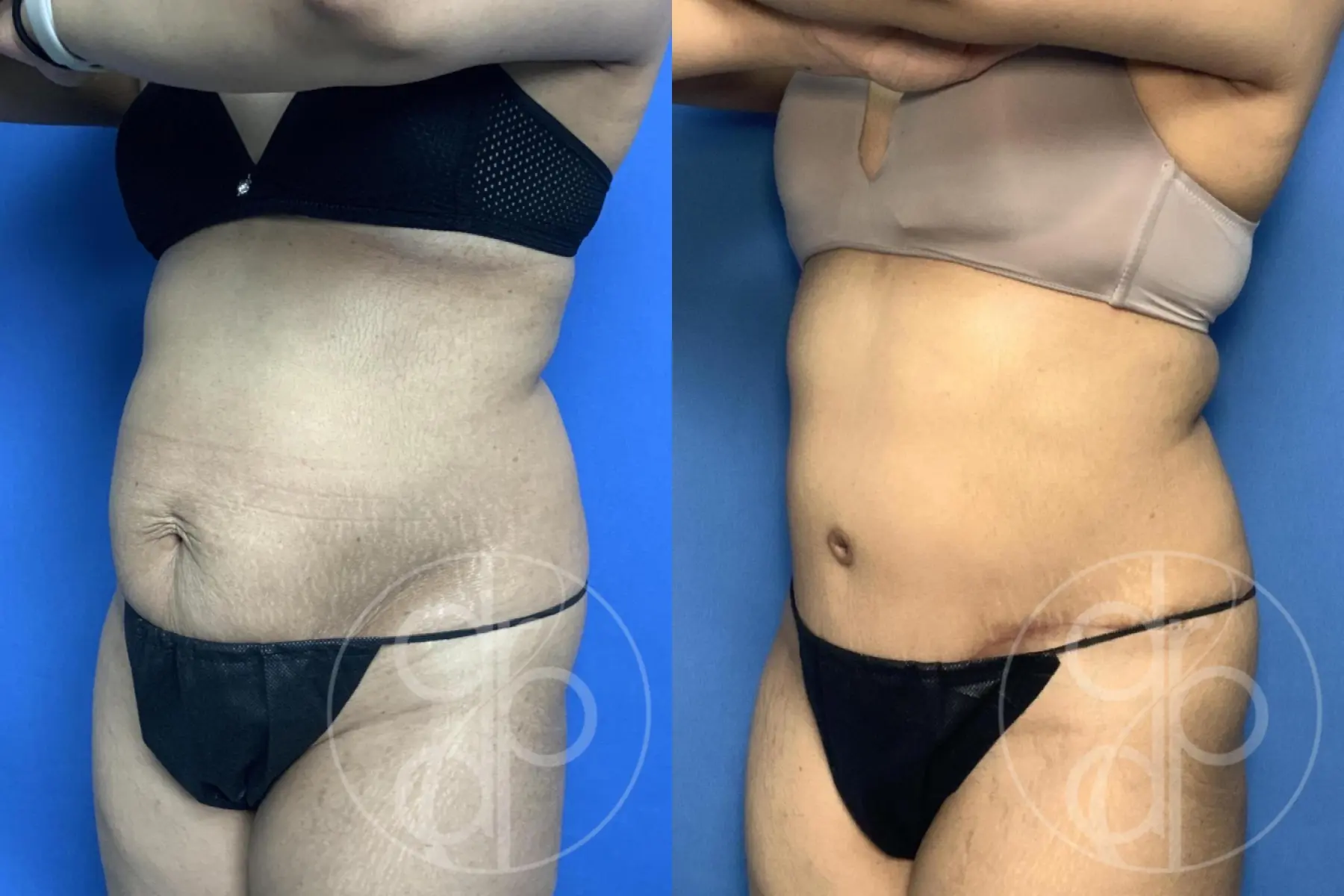 Abdominoplasty: Patient 37 - Before and After 2