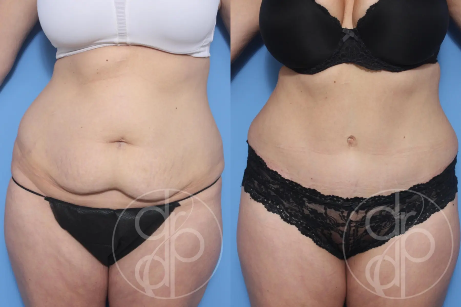 patient 12941 tummy tuck before and after result - Before and After