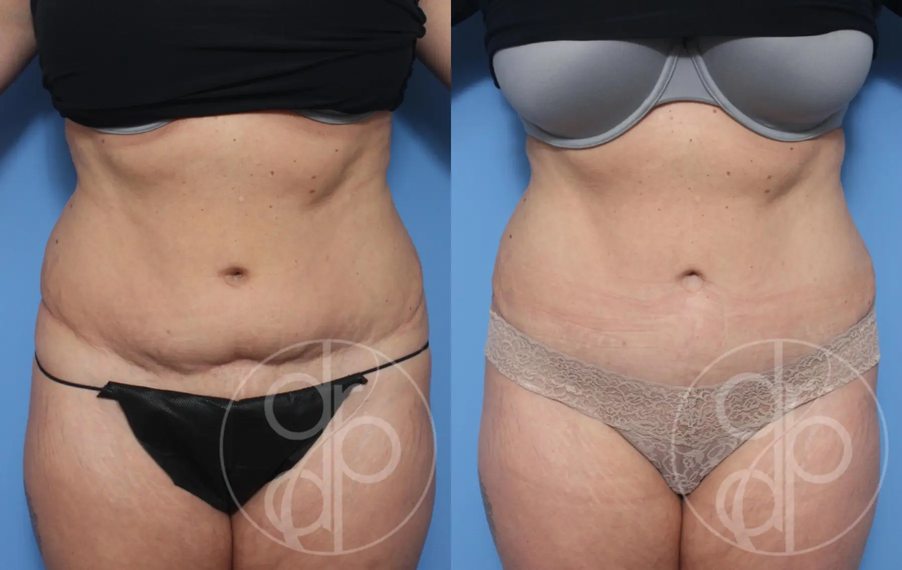Abdominoplasty-revision: Patient 1 - Before and After  