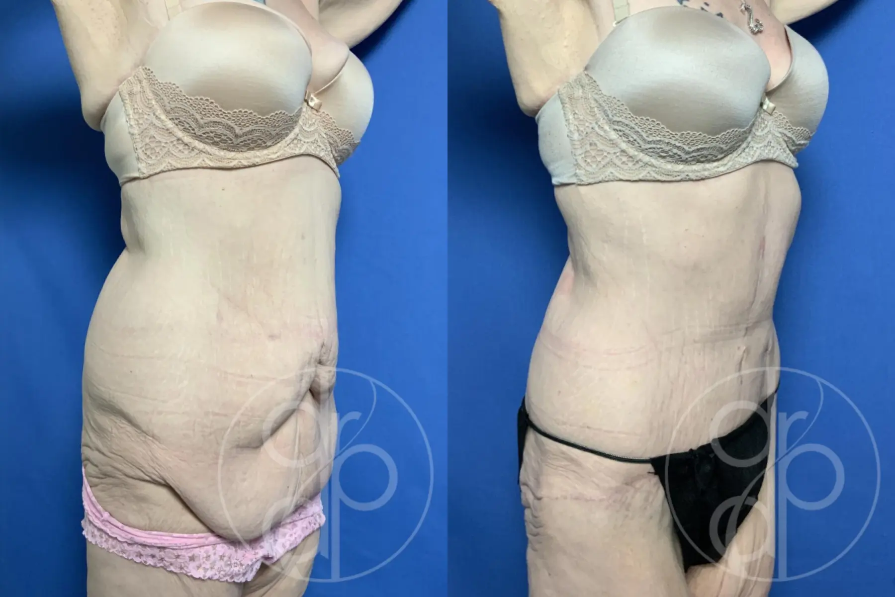 patient 12189 panniculectomy before and after result - Before and After 2