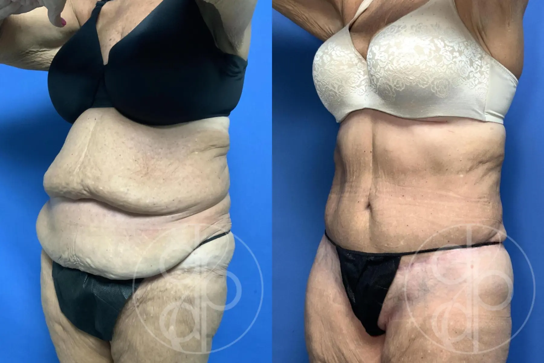 Abdominoplasty: Patient 36 - Before and After 3