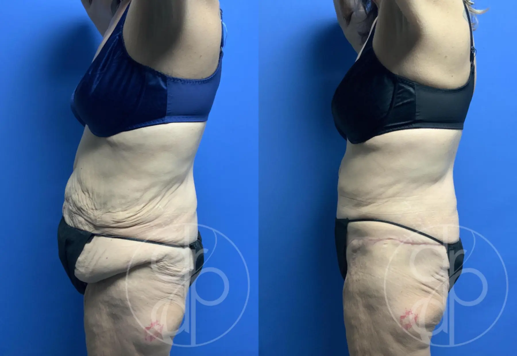 patient 12155 tummy tuck before and after result - Before and After 2