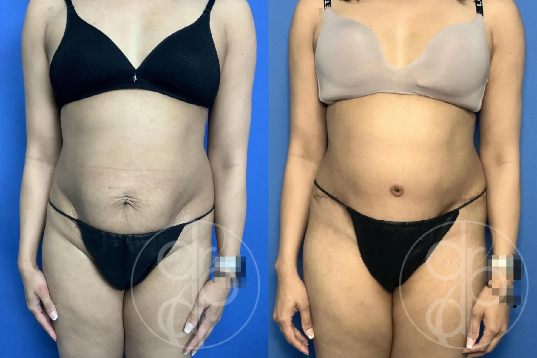 Abdominoplasty: Patient 37 - Before and After 1